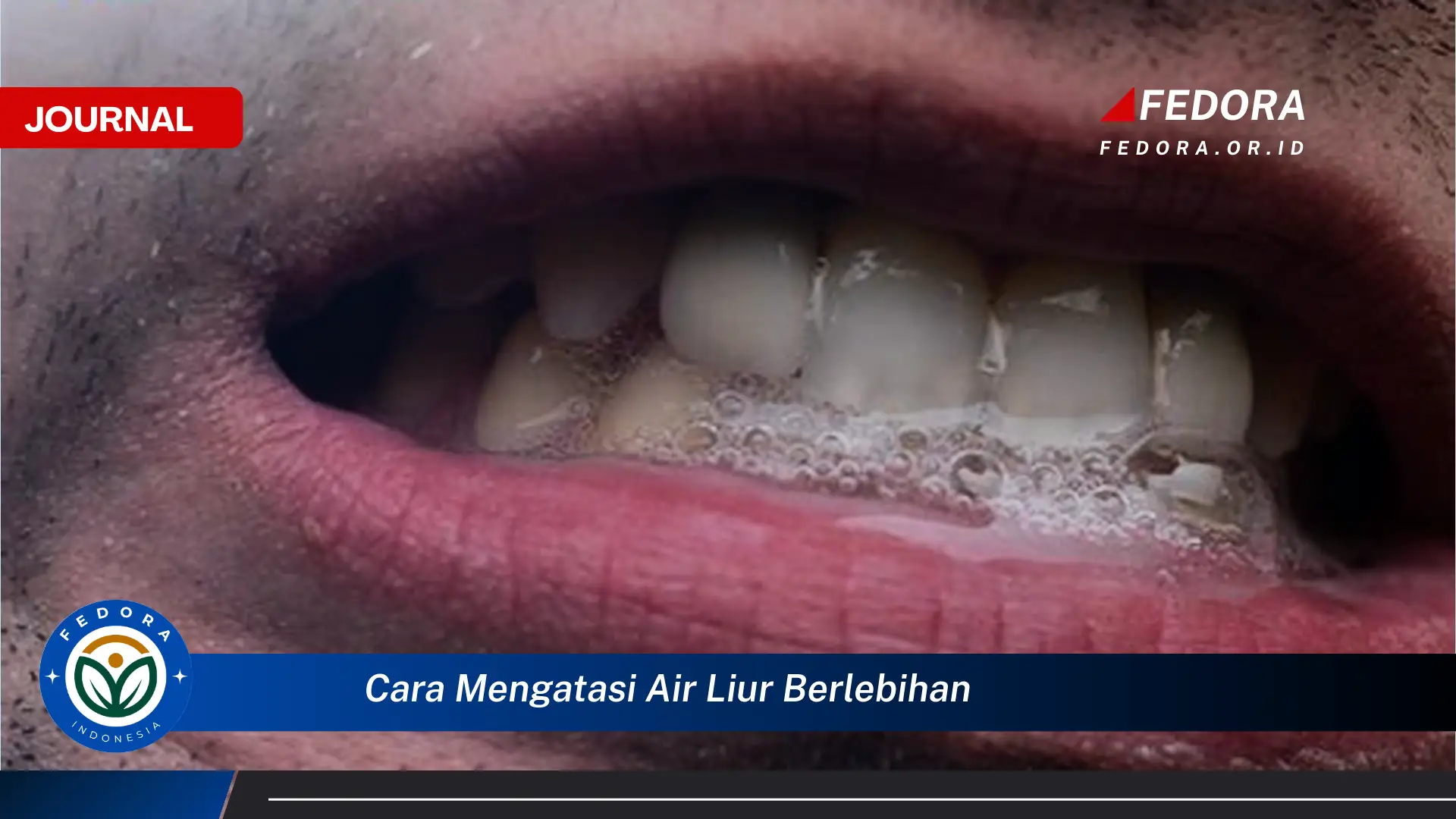 Ketahui Cara Mengatasi Air Liur Berlebihan Secara Efektif dan Alami