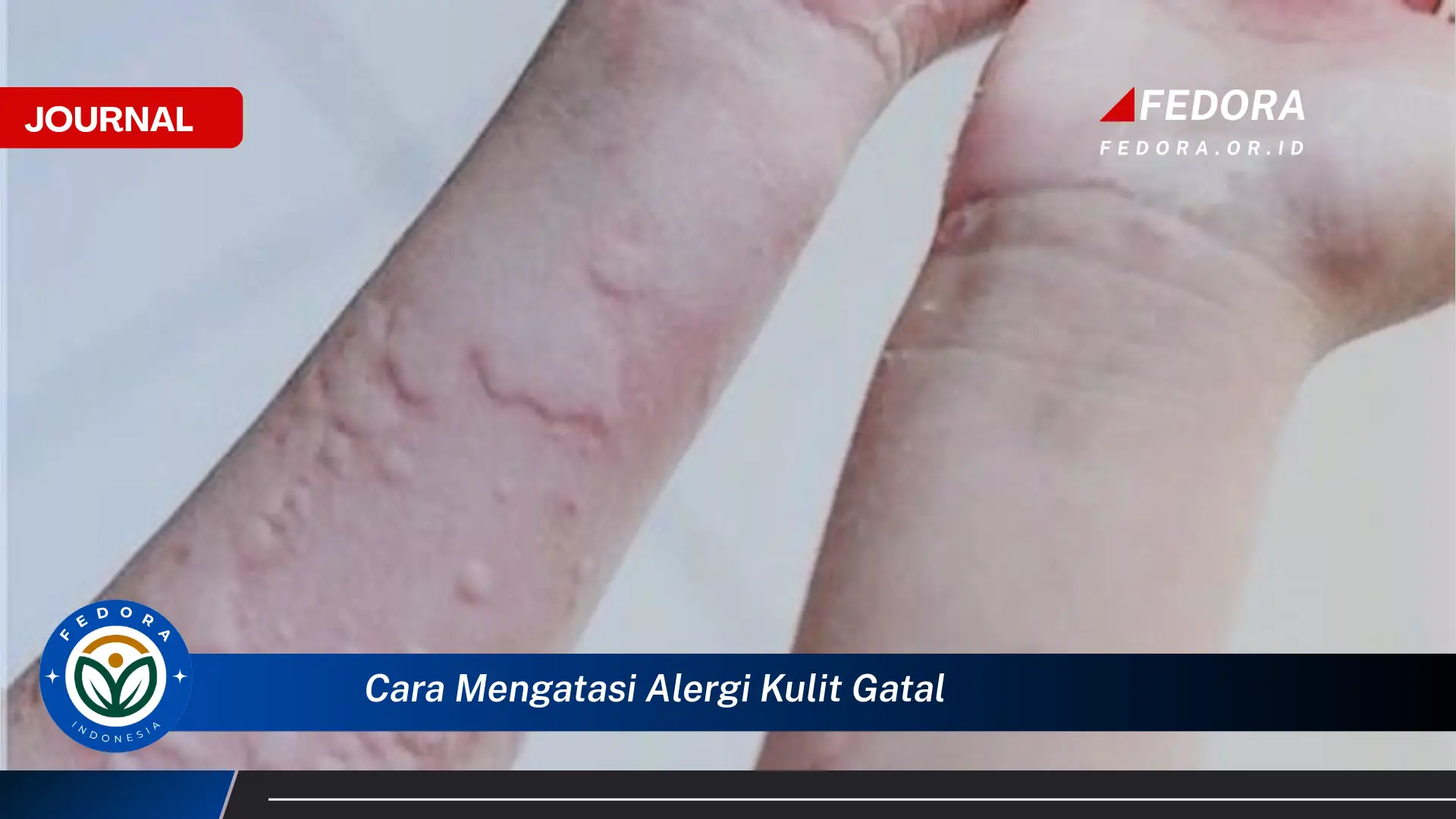 Ketahui Cara Mengatasi Alergi Kulit Gatal dengan Cepat dan Ampuh