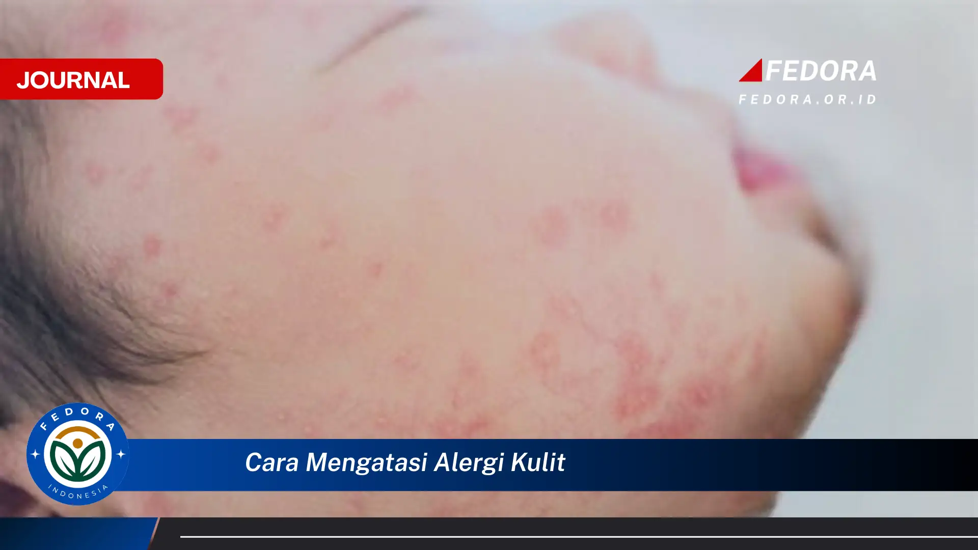 Ketahui Cara Mengatasi Alergi Kulit dengan Cepat dan Alami