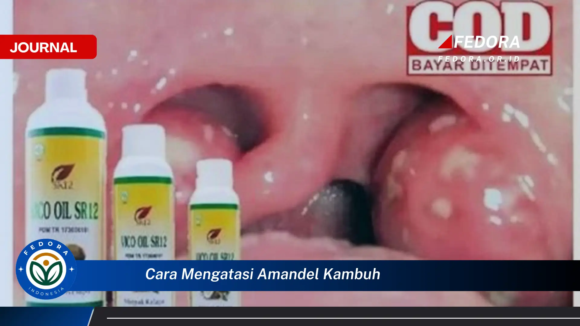 Ketahui Cara Mengatasi Amandel Kambuh dengan Cepat dan Efektif
