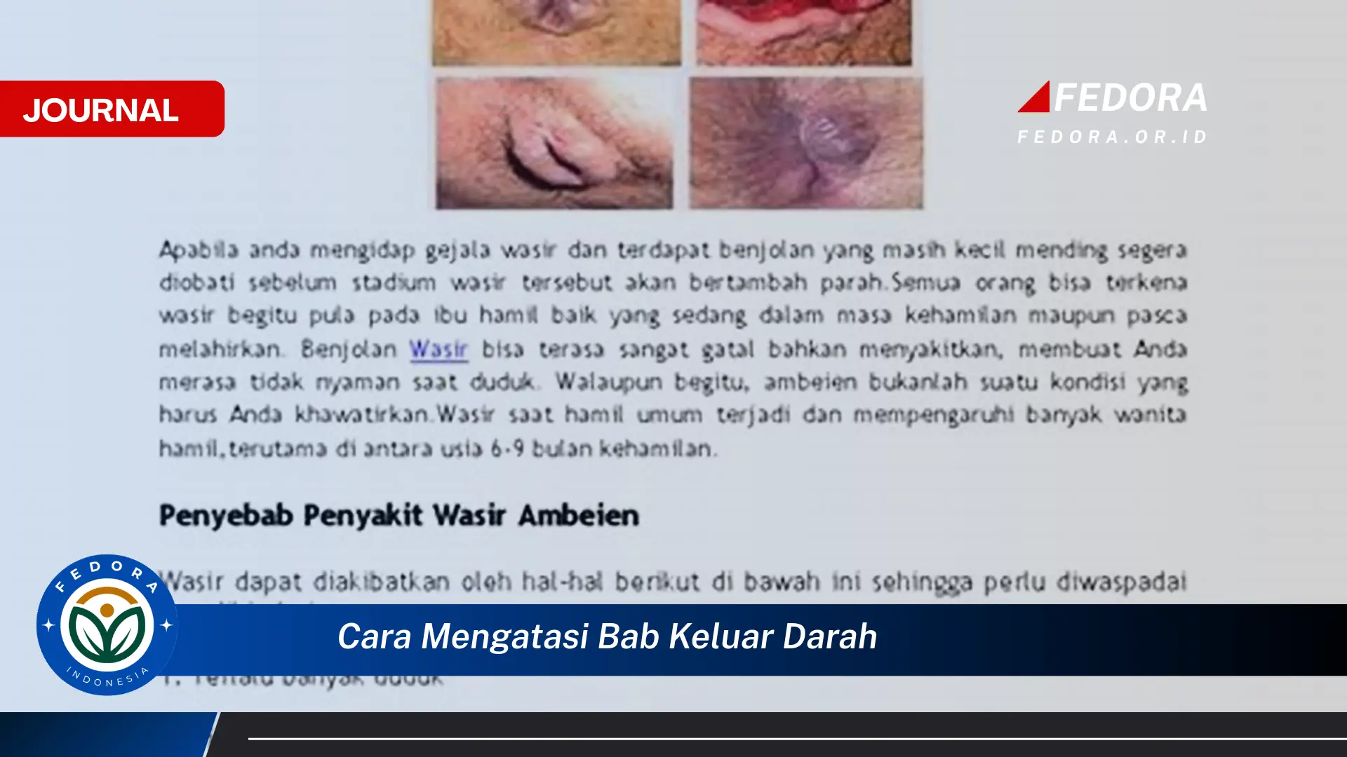 Ketahui Cara Mengatasi BAB Keluar Darah Secara Efektif dan Aman
