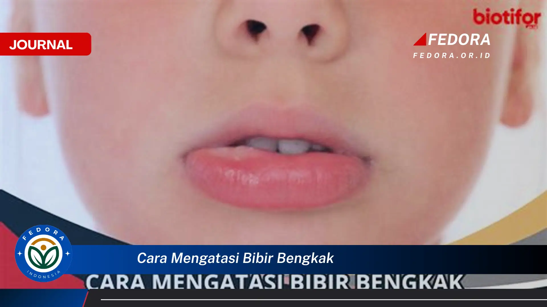 Ketahui Cara Mengatasi Bibir Bengkak Secara Alami dan Medis