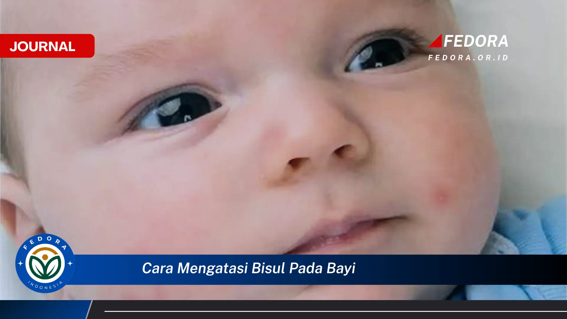 Ketahui Cara Mengatasi Bisul Pada Bayi Dengan Cepat dan Aman