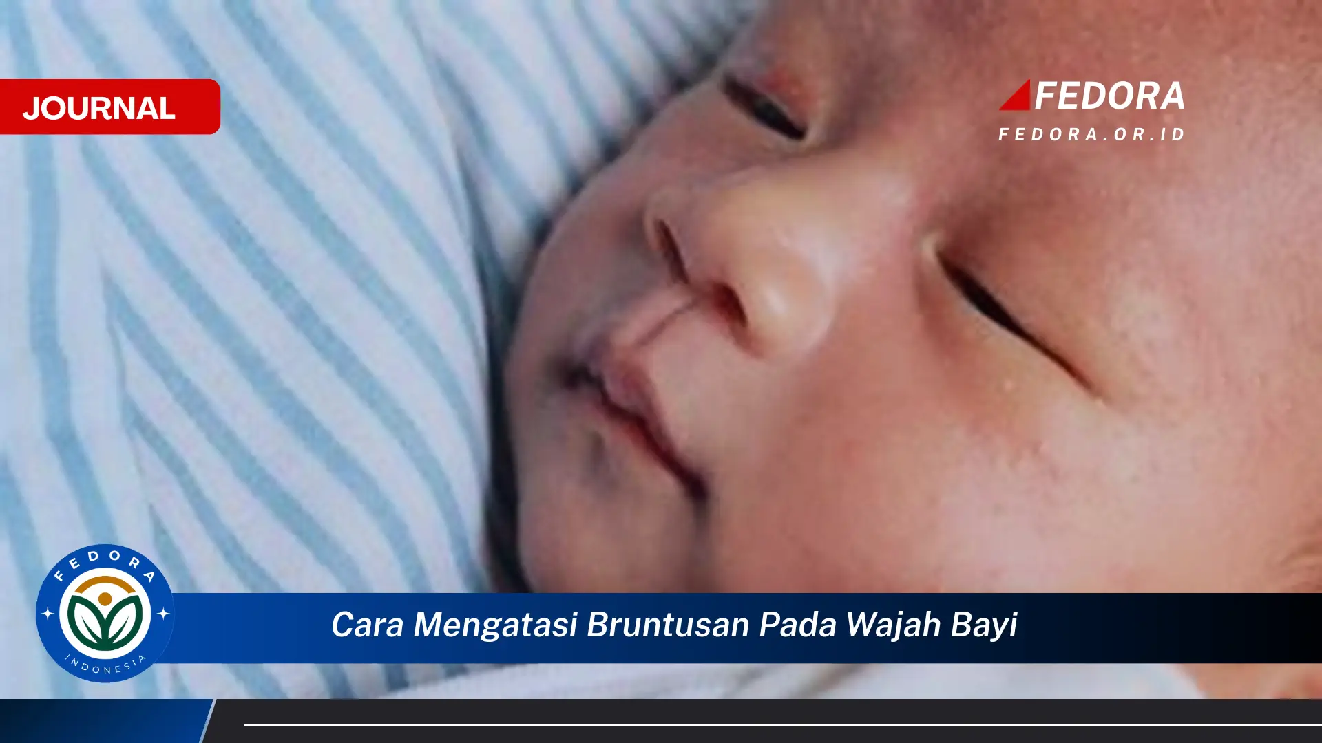 Ketahui Cara Mengatasi Bruntusan Pada Wajah Bayi Dengan Cepat dan Aman