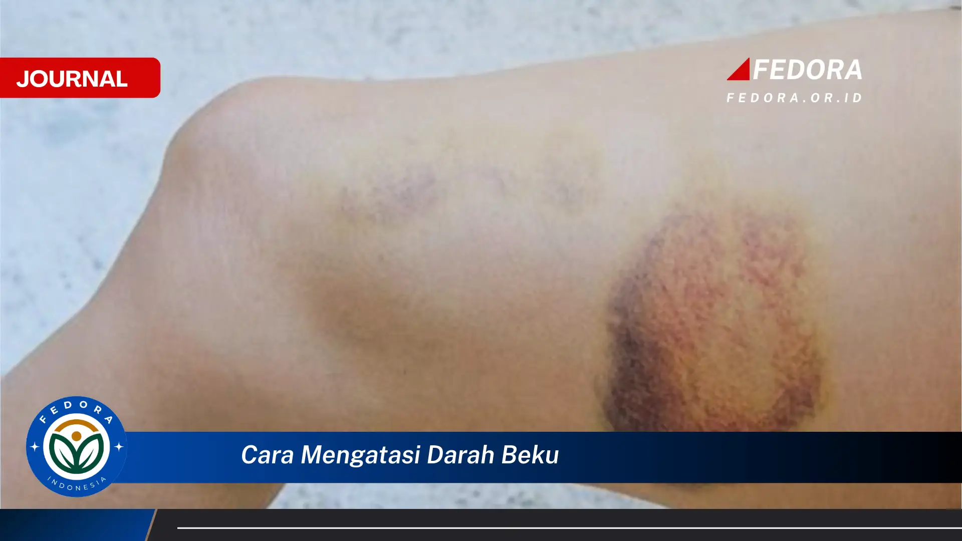 Ketahui Cara Mengatasi Darah Beku Secara Alami dan Medis