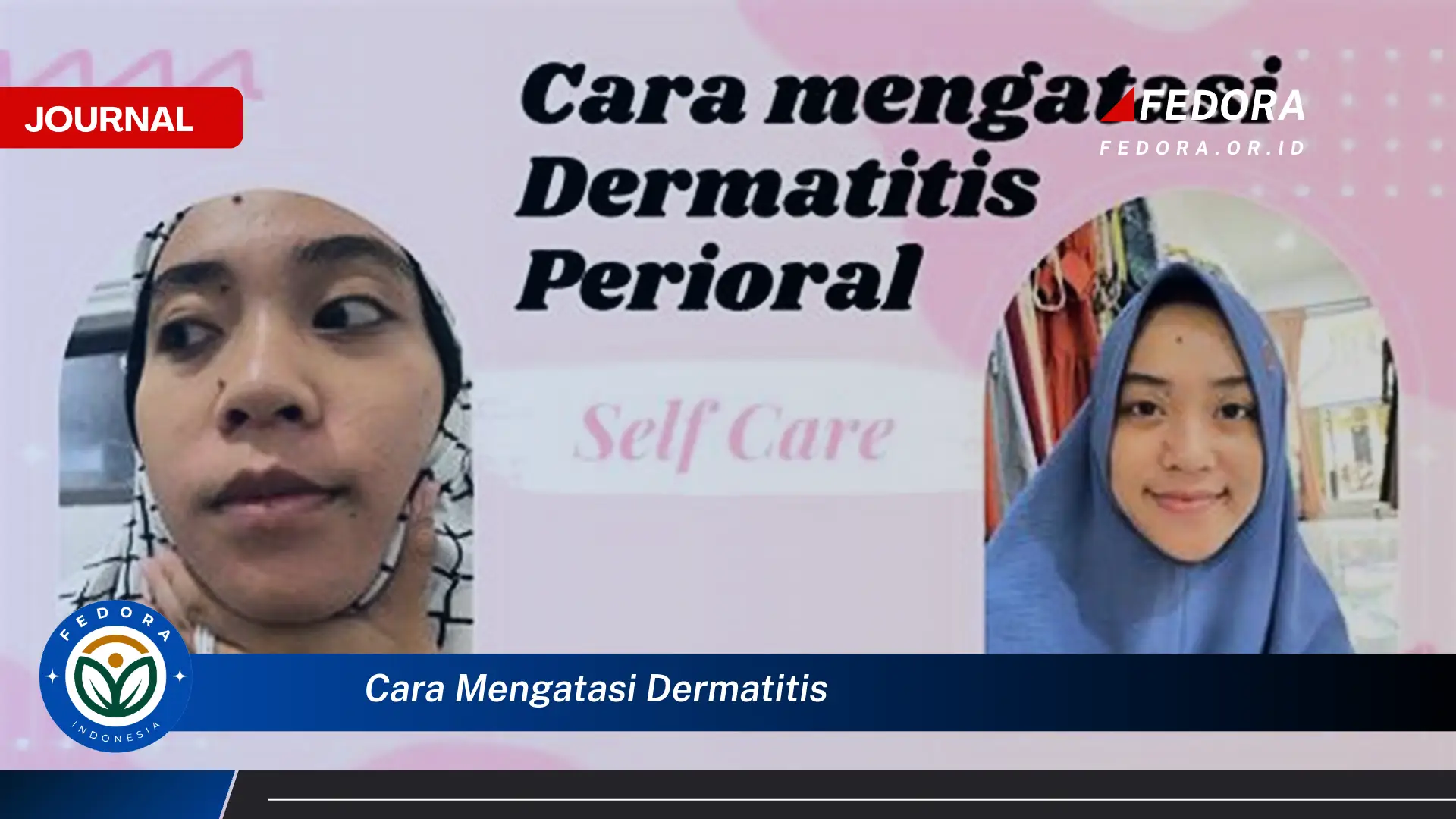 Ketahui Cara Mengatasi Dermatitis, Panduan Lengkap untuk Kulit Sehat dan Bebas Gatal