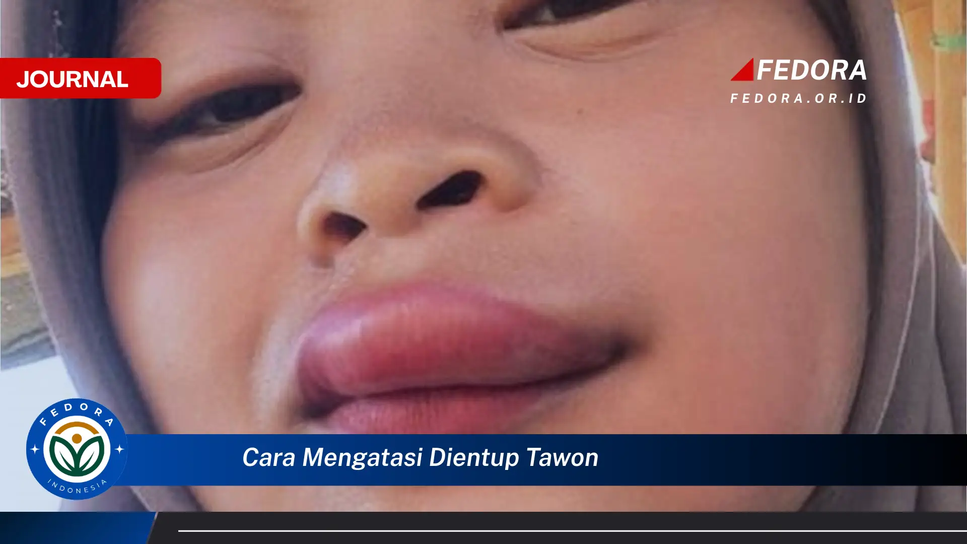 Ketahui Cara Mengatasi Dientup Tawon, Pertolongan Pertama dan Pencegahan Efektif