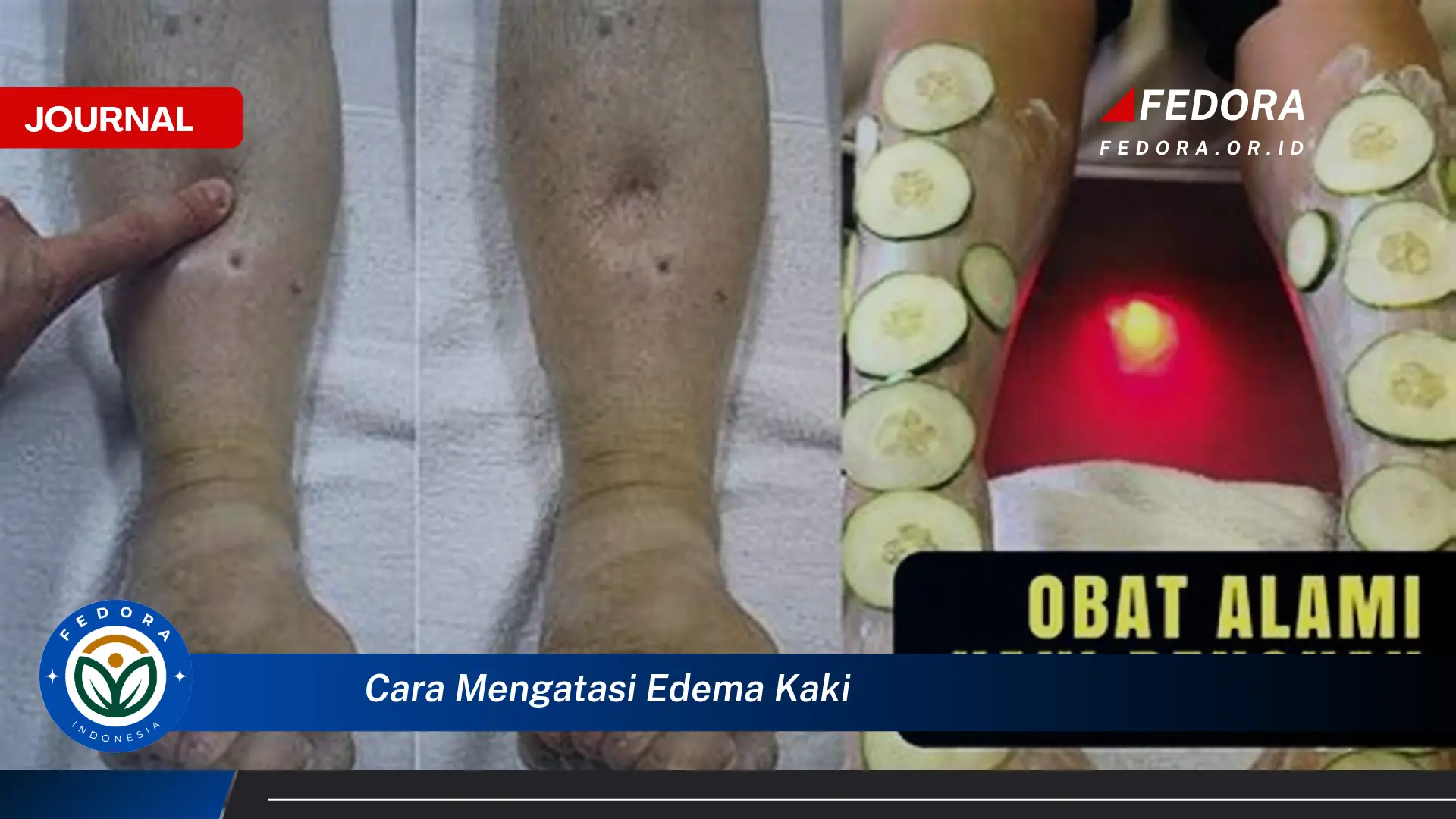 Ketahui Cara Mengatasi Edema Kaki Secara Alami dan Medis