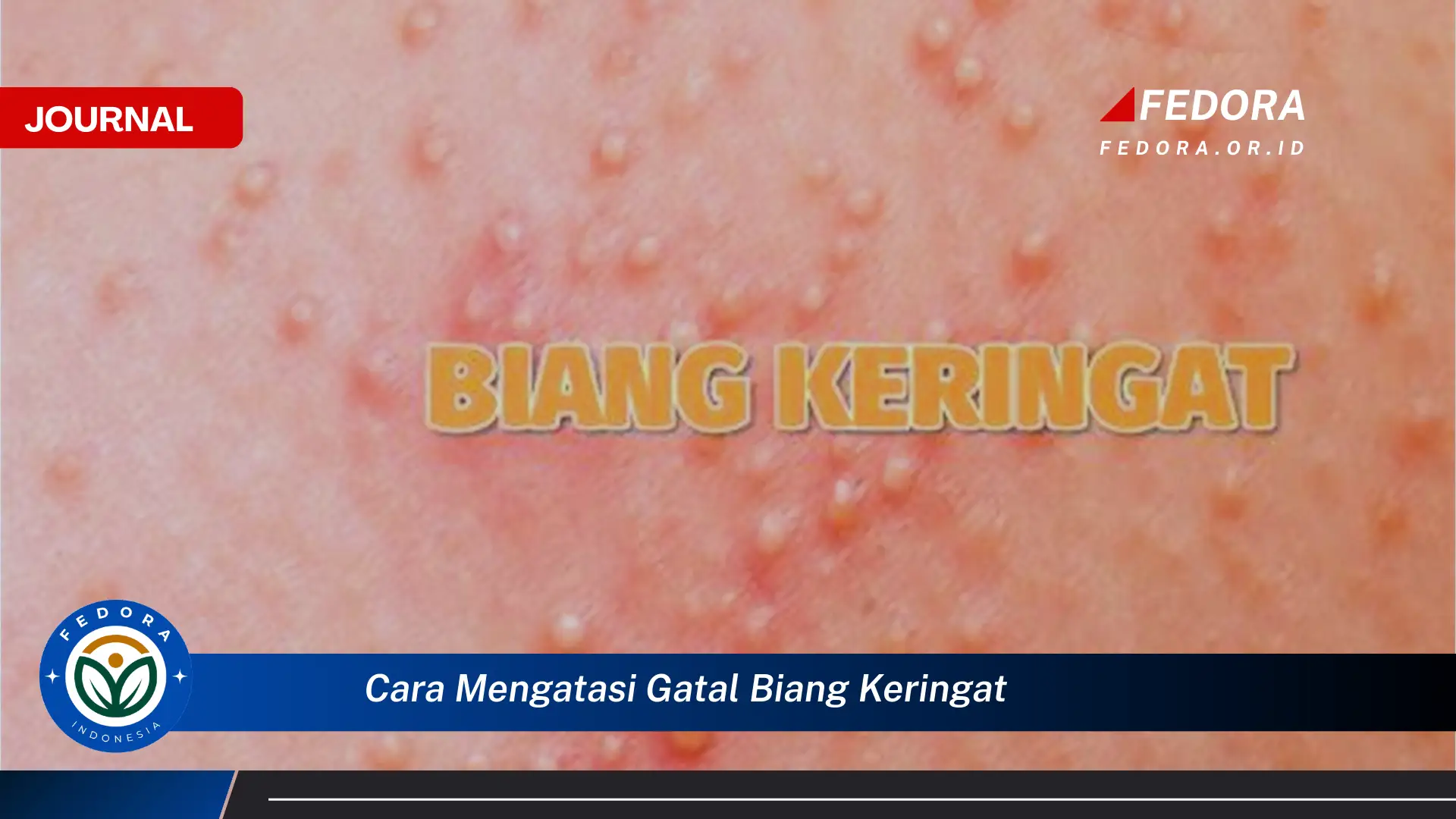 Inilah Cara Mengatasi Gatal Biang Keringat dengan Cepat dan Alami