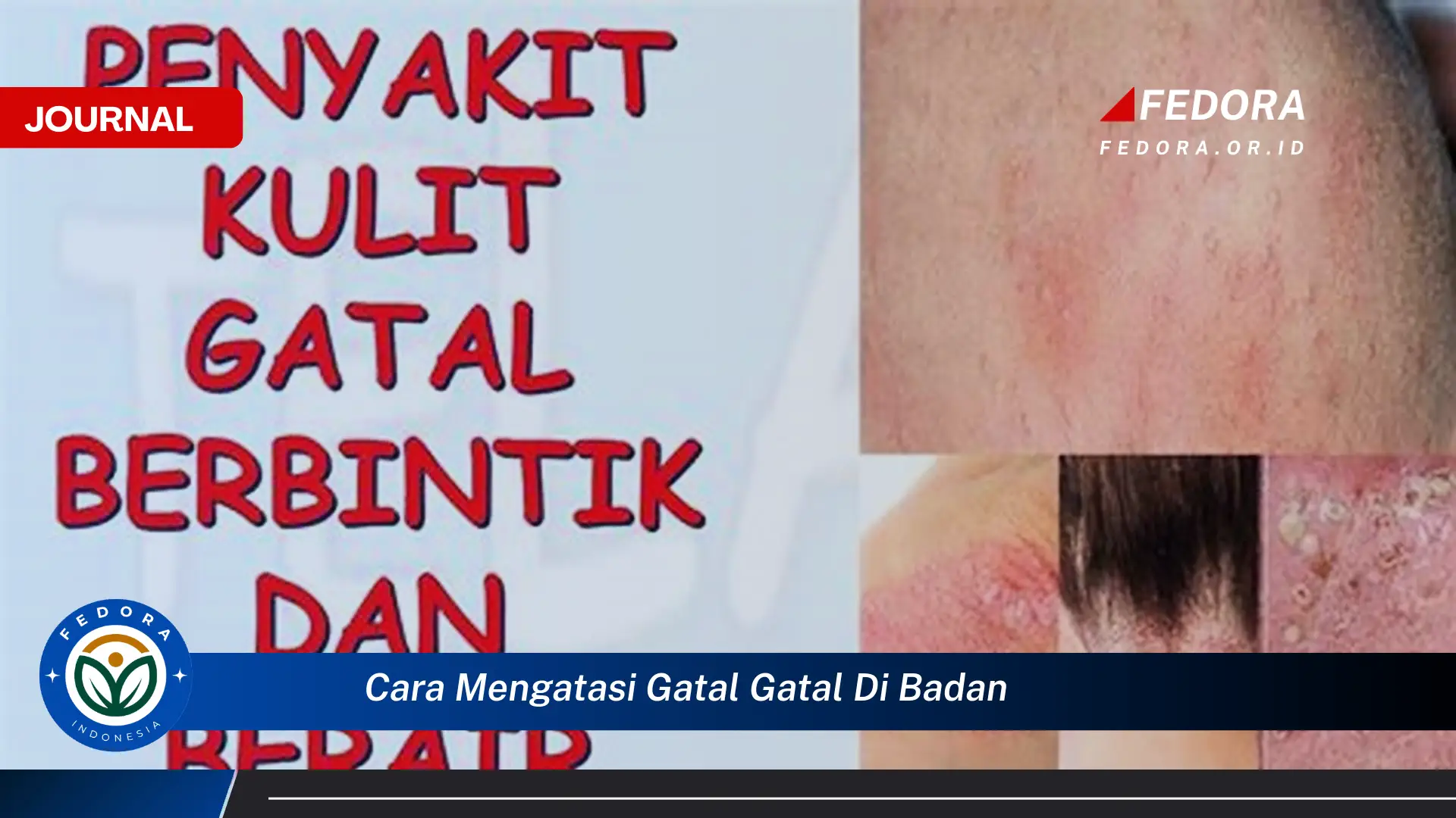 Ketahui Cara Mengatasi Gatal,Gatal di Badan Secara Alami dan Medis