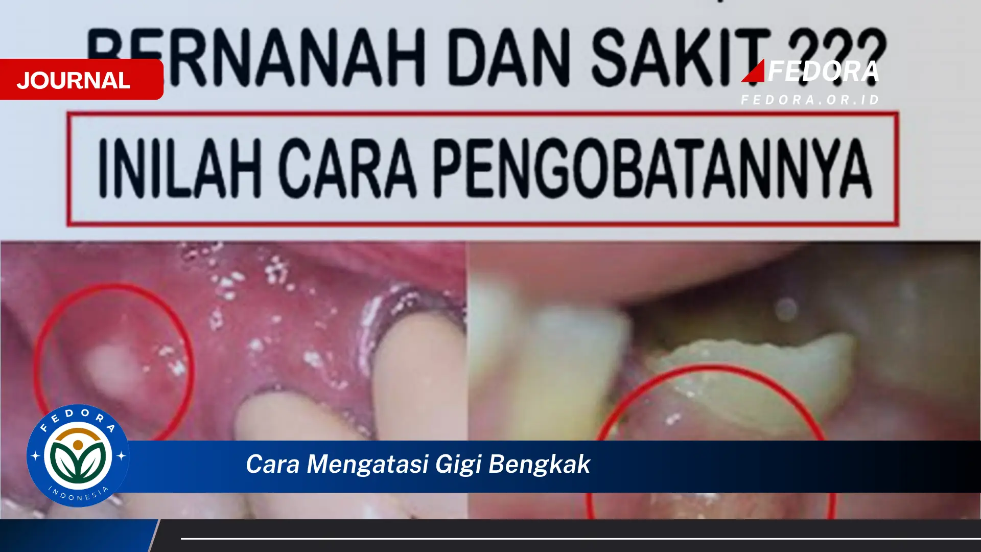 Ketahui Cara Mengatasi Gigi Bengkak Secara Alami dan Medis
