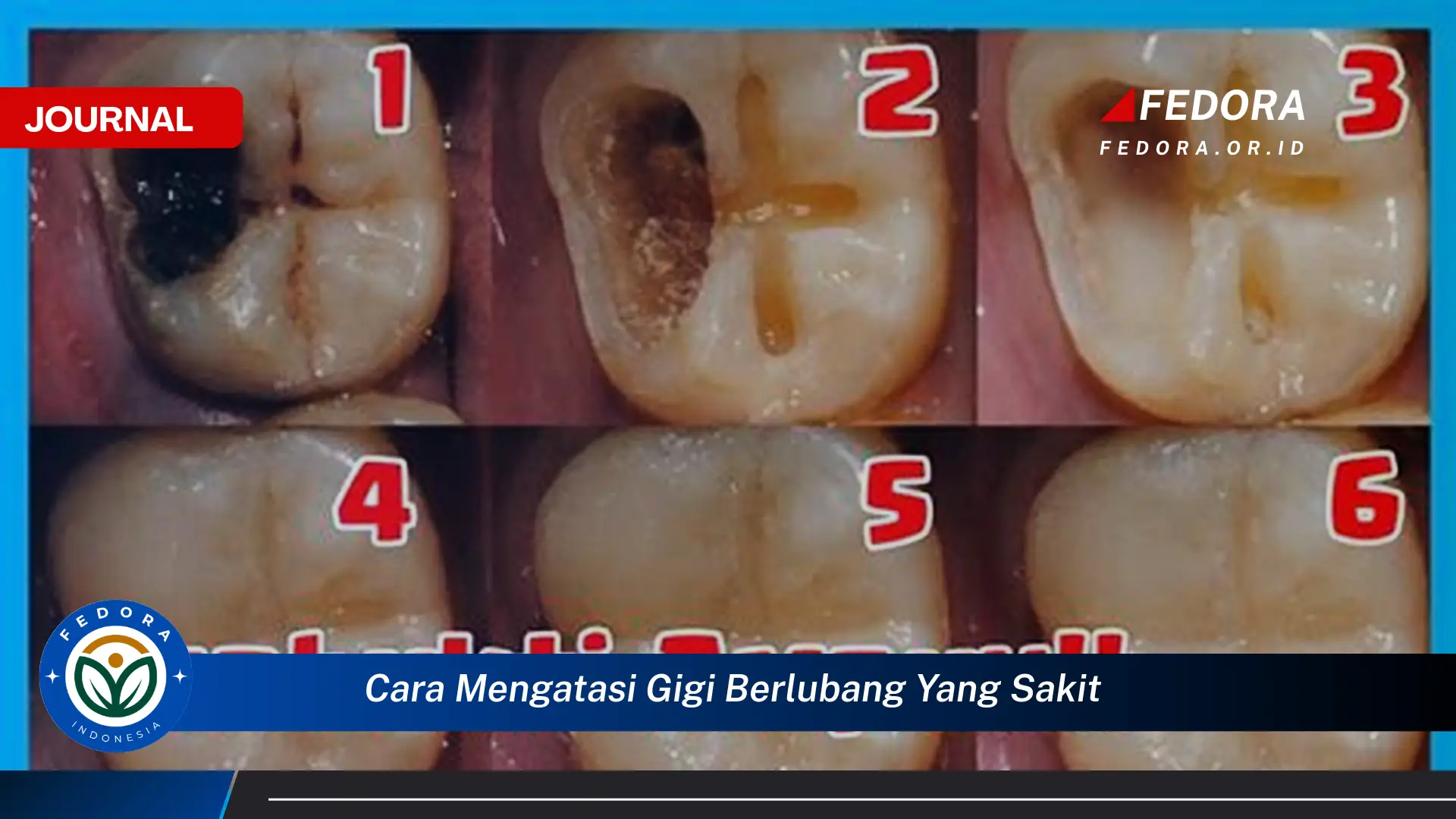 Ketahui Cara Mengatasi Gigi Berlubang yang Sakit dengan Cepat dan Efektif