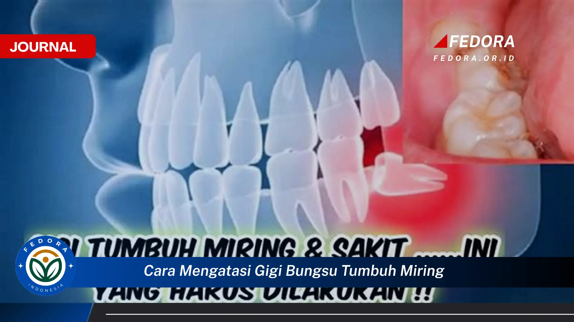Ketahui Cara Mengatasi Gigi Bungsu Tumbuh Miring dan Rasa Sakit yang Ditimbulkannya