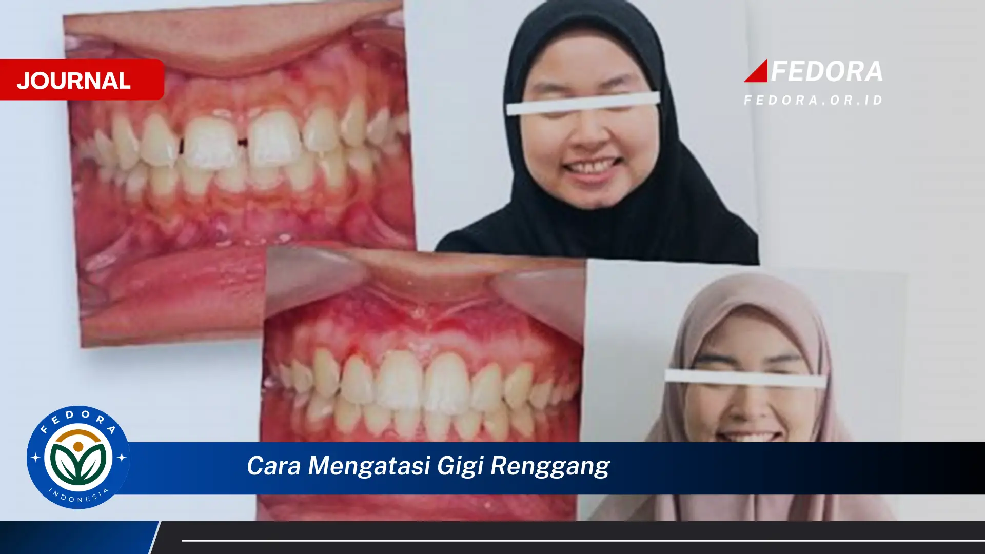 Ketahui Cara Mengatasi Gigi Renggang Secara Efektif dan Alami