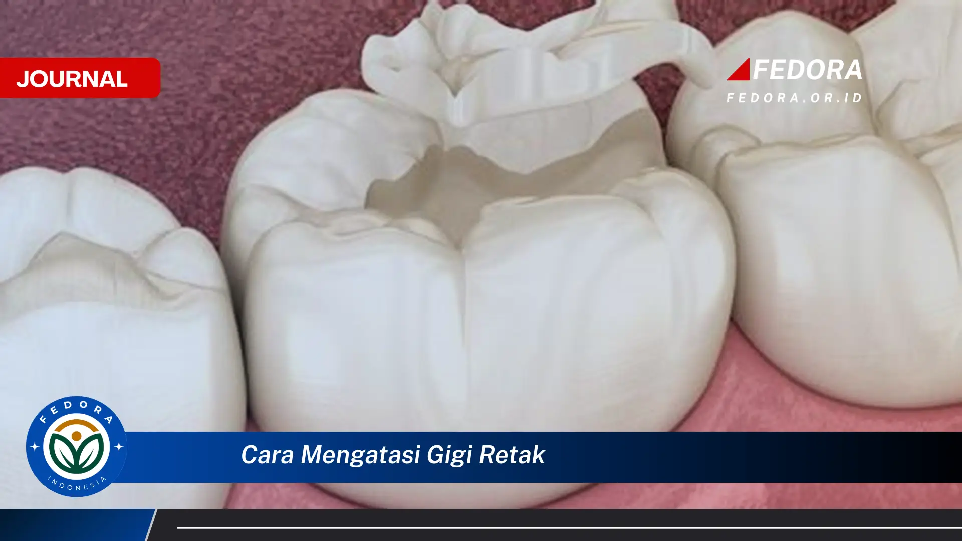 Ketahui Cara Mengatasi Gigi Retak, Panduan Lengkap dan Efektif