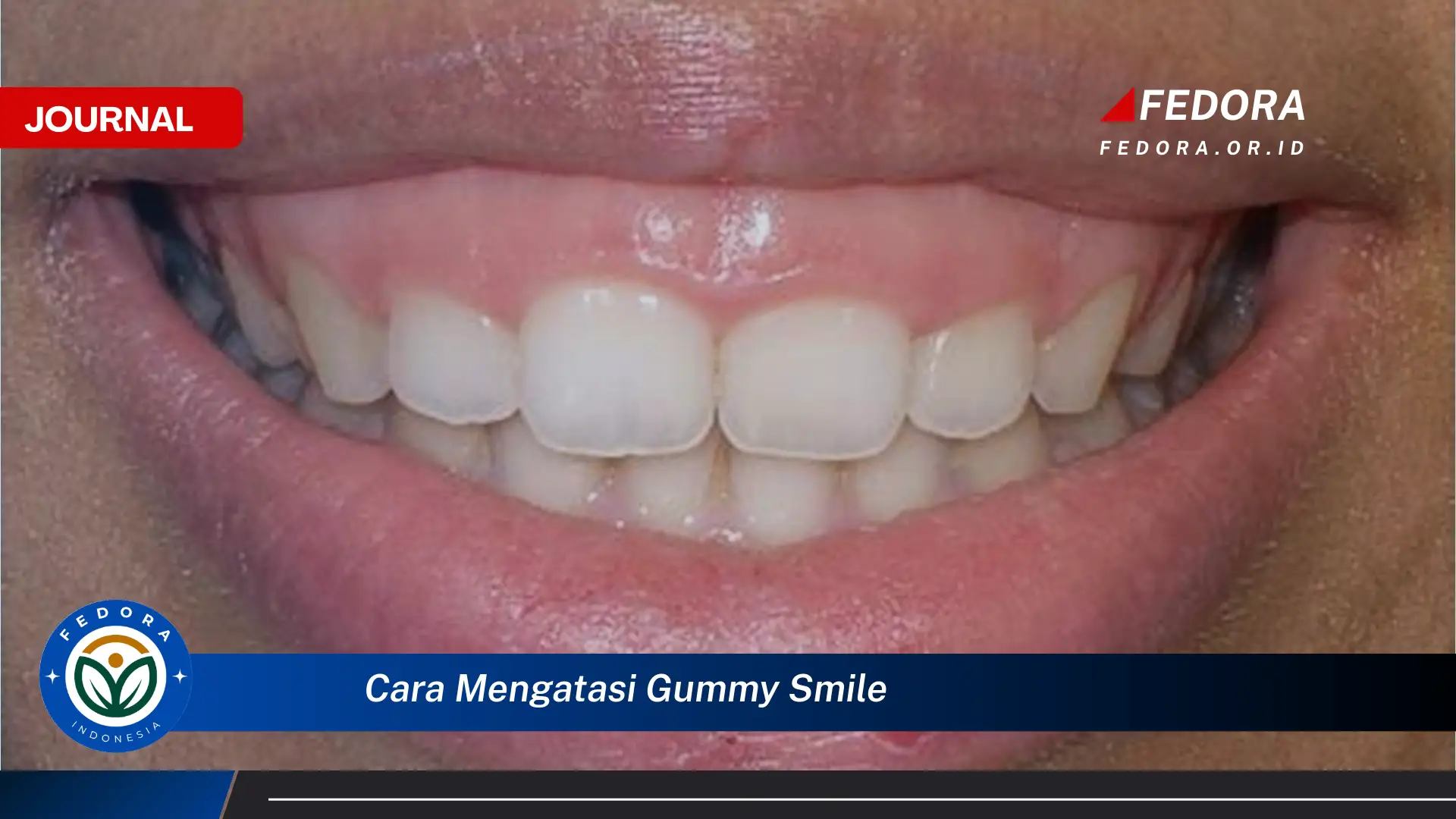 Temukan Cara Mengatasi Gummy Smile Secara Efektif dan Alami