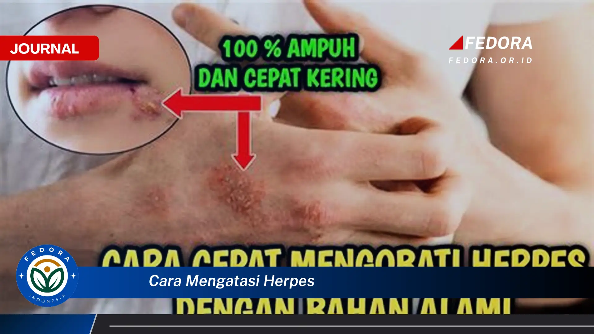 Ketahui Cara Mengatasi Herpes Secara Alami dan Efektif