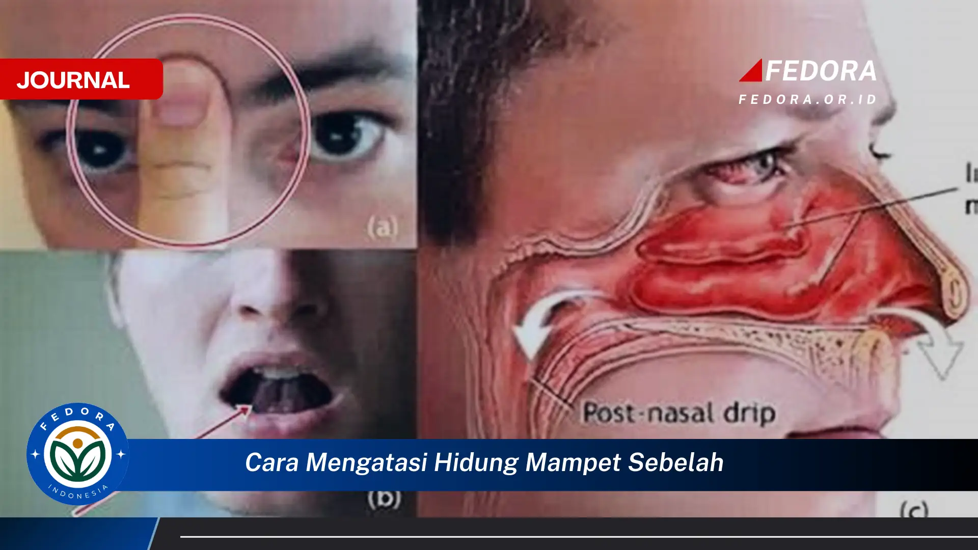 Ketahui Cara Mengatasi Hidung Mampet Sebelah Secara Alami dan Efektif Ketahui Cara Mengatasi Hidung Mampet Sebelah Secara Alami dan Efektif
