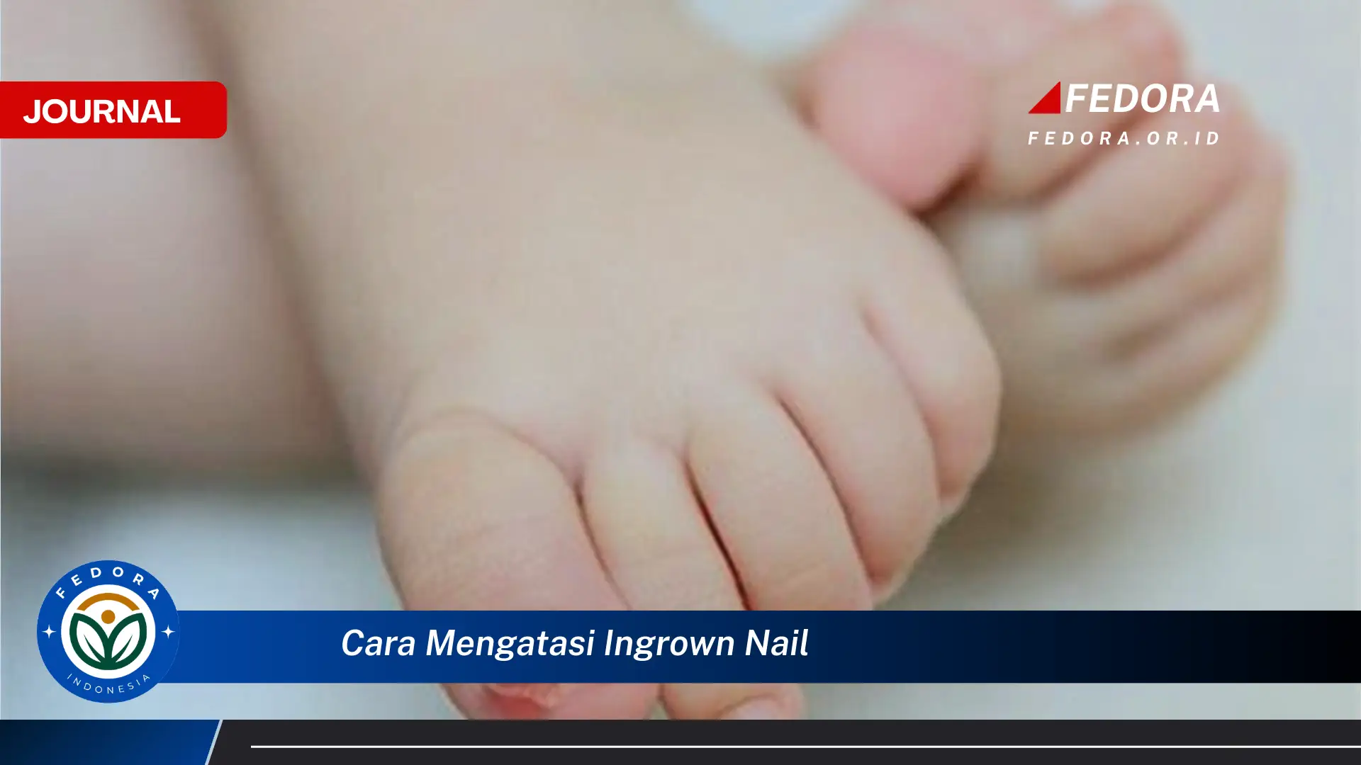 Ketahui Cara Mengatasi Ingrown Nail Secara Efektif dan Alami di Rumah