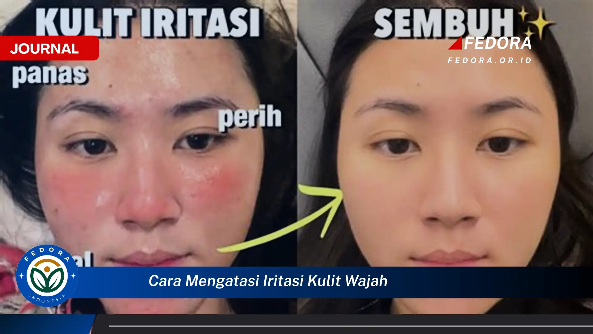 Ketahui Cara Mengatasi Iritasi Kulit Wajah dengan Cepat dan Alami