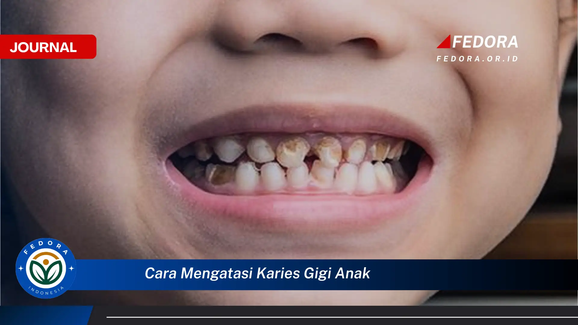 Ketahui Cara Mencegah dan Mengatasi Karies Gigi Anak Secara Efektif