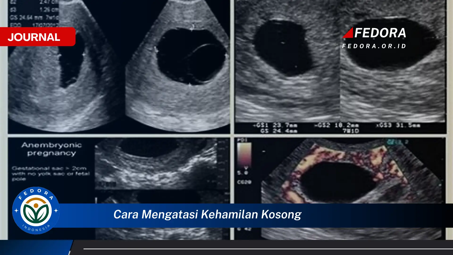 Ketahui Cara Mengatasi Kehamilan Kosong, Dukungan Emosional dan Langkah Selanjutnya