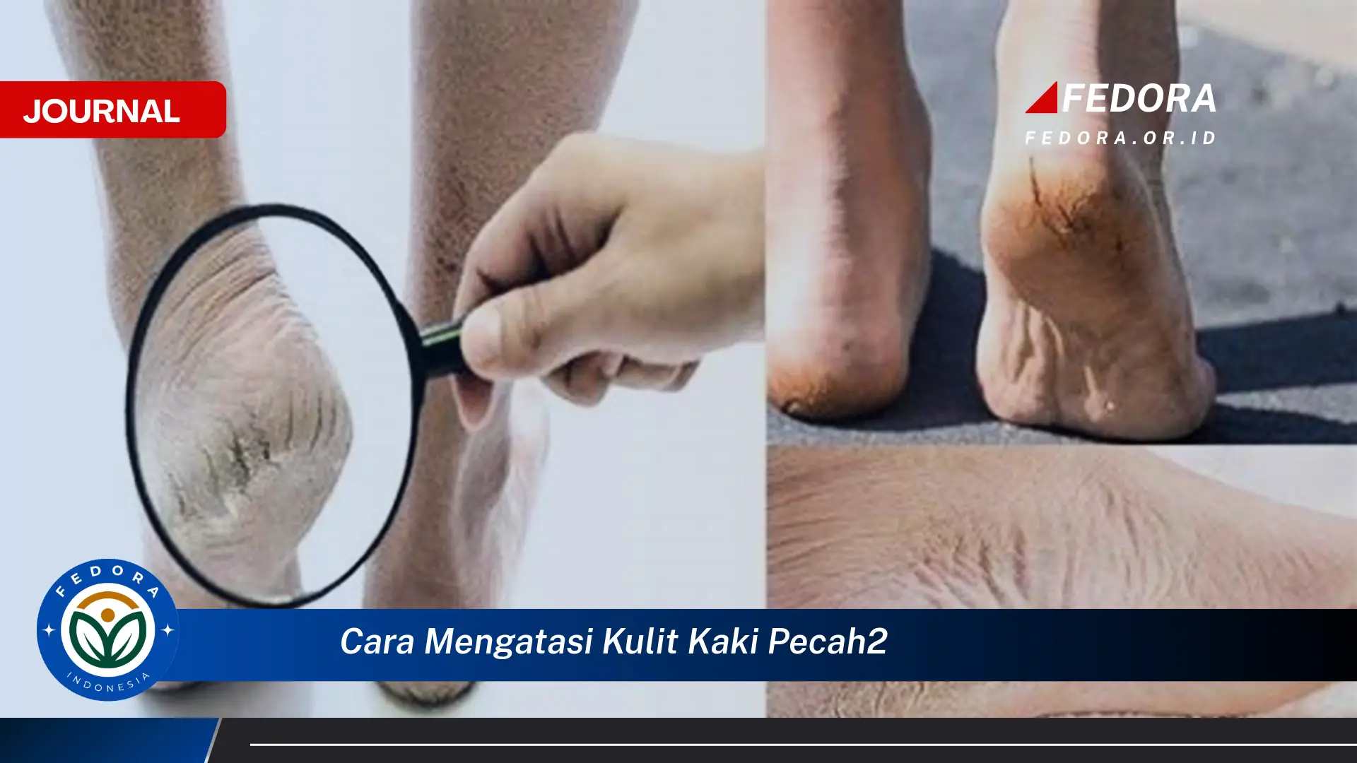 Ketahui Cara Mengatasi Kulit Kaki Pecah,Pecah Secara Alami dan Efektif