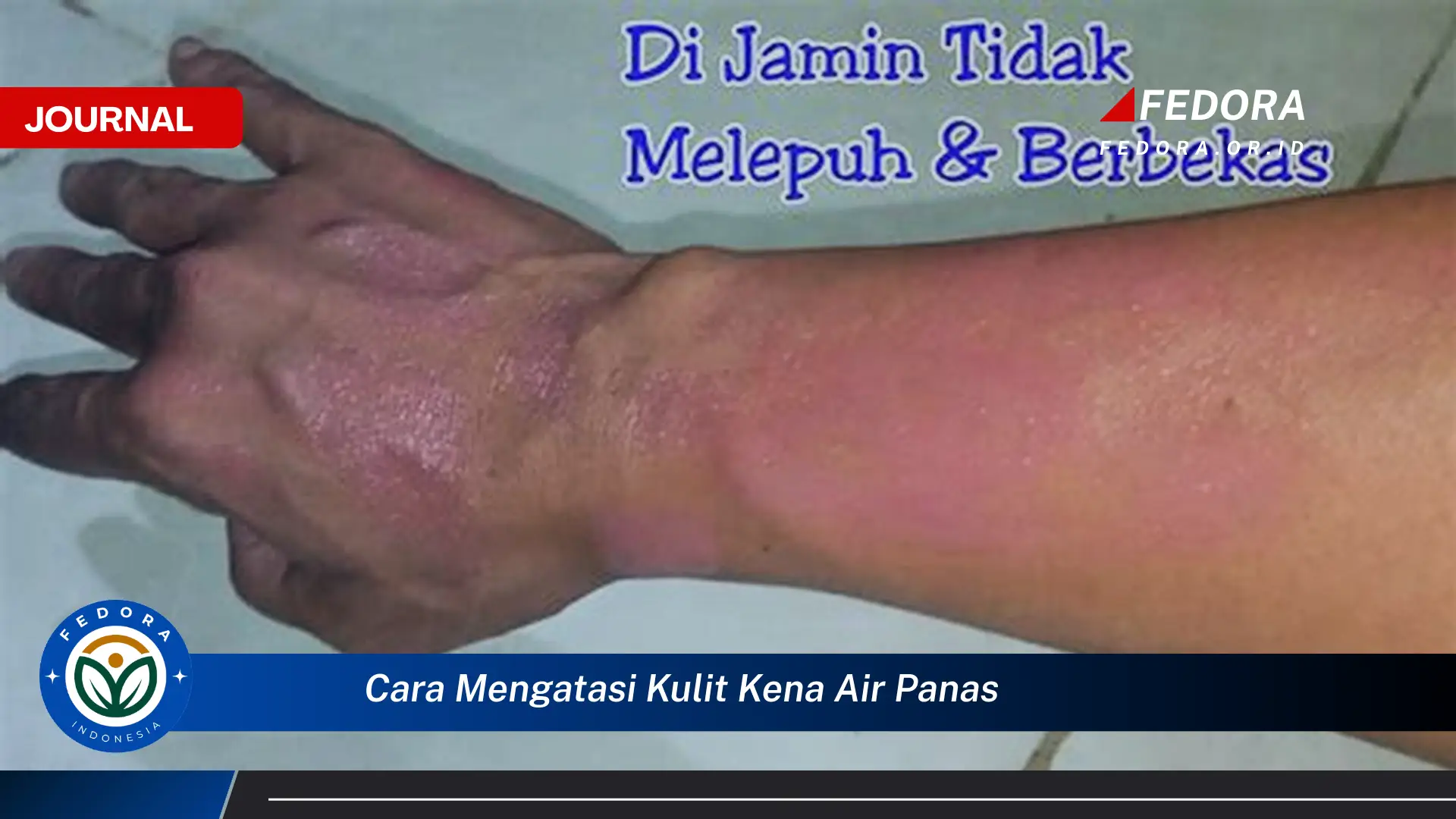 Ketahui Cara Mengatasi Kulit Terkena Air Panas dengan Cepat dan Efektif