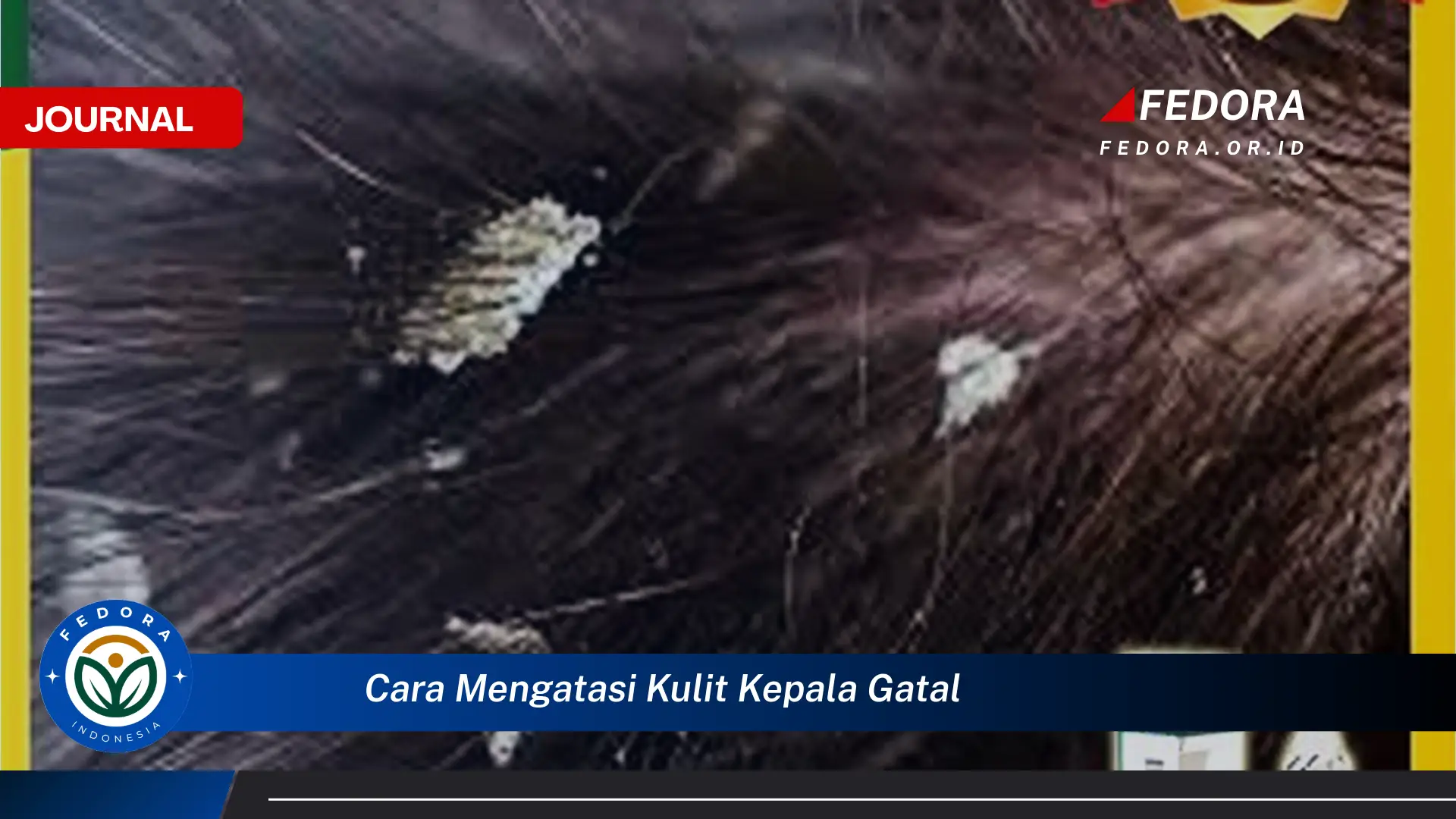 Ketahui Cara Mengatasi Kulit Kepala Gatal Secara Alami dan Efektif