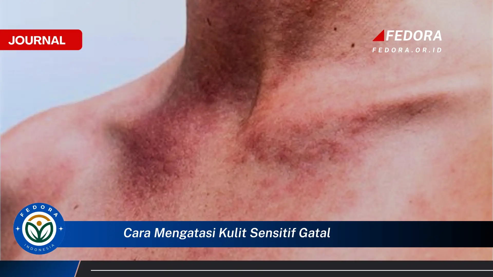 Ketahui Cara Mengatasi Kulit Sensitif Gatal dan Iritasi Secara Alami dan Efektif