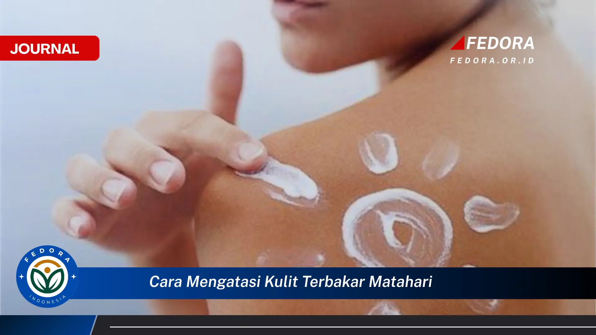 Ketahui Cara Mengatasi Kulit Terbakar Matahari dengan Cepat dan Alami