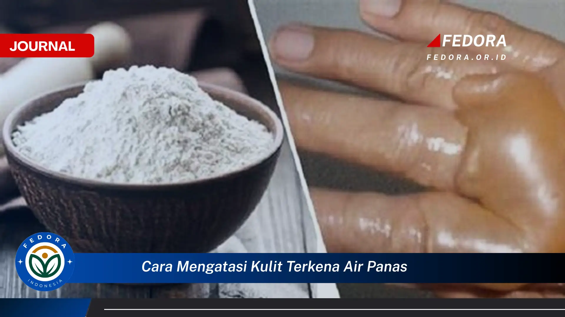 Ketahui Cara Mengatasi Kulit Terkena Air Panas, Pertolongan Pertama dan Tips Cepat Redakan Rasa Sakit Ketahui Cara Mengatasi Kulit Terkena Air Panas, Pertolongan Pertama dan Tips Cepat Redakan Rasa Sakit