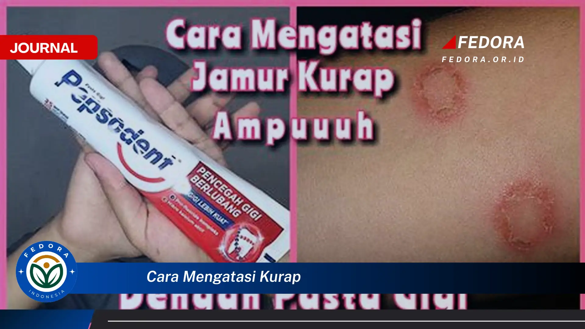 Ketahui Cara Mengatasi Kurap dengan Cepat dan Ampuh