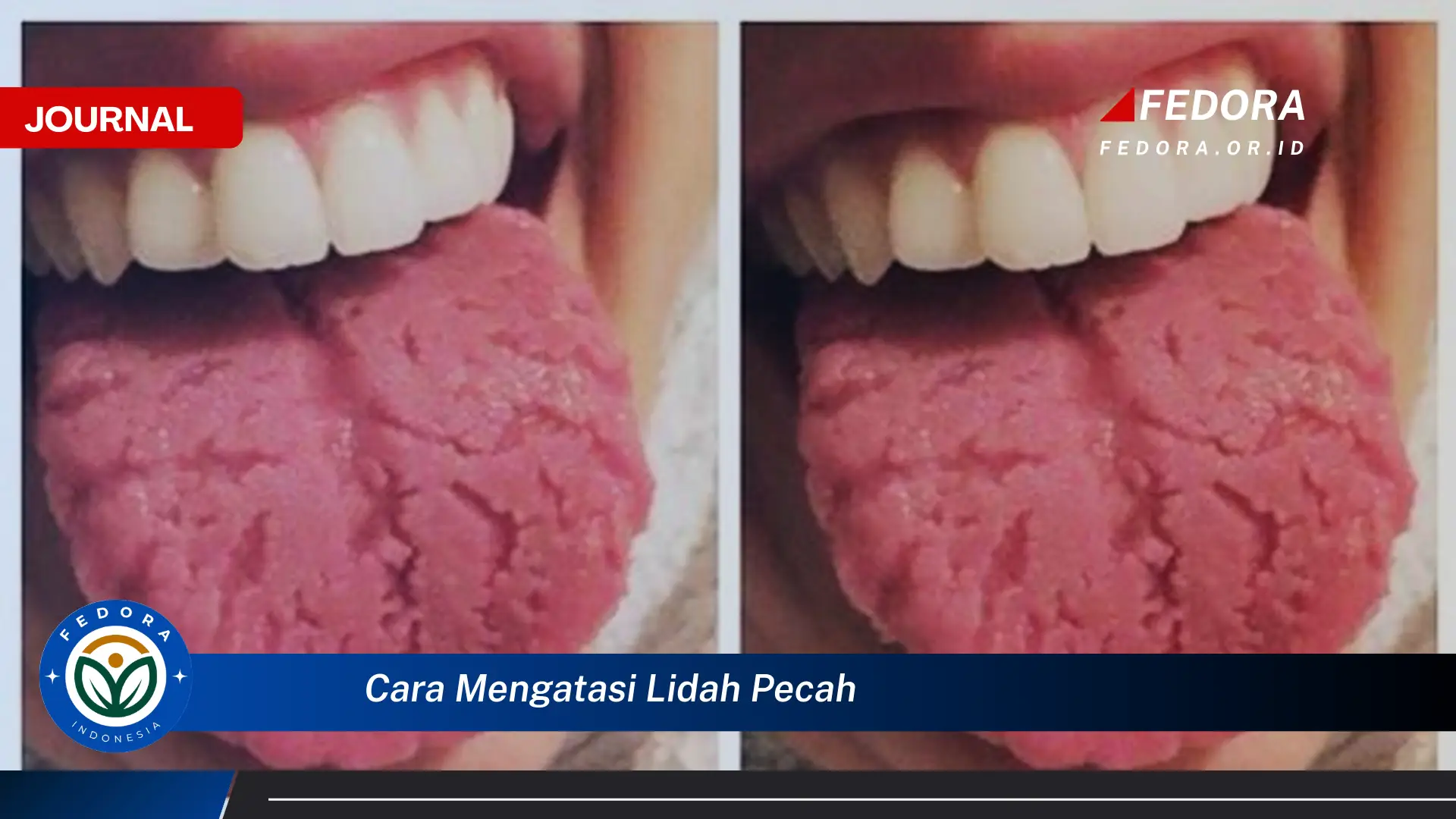 Ketahui Cara Mengatasi Lidah Pecah,Pecah Secara Alami dan Efektif