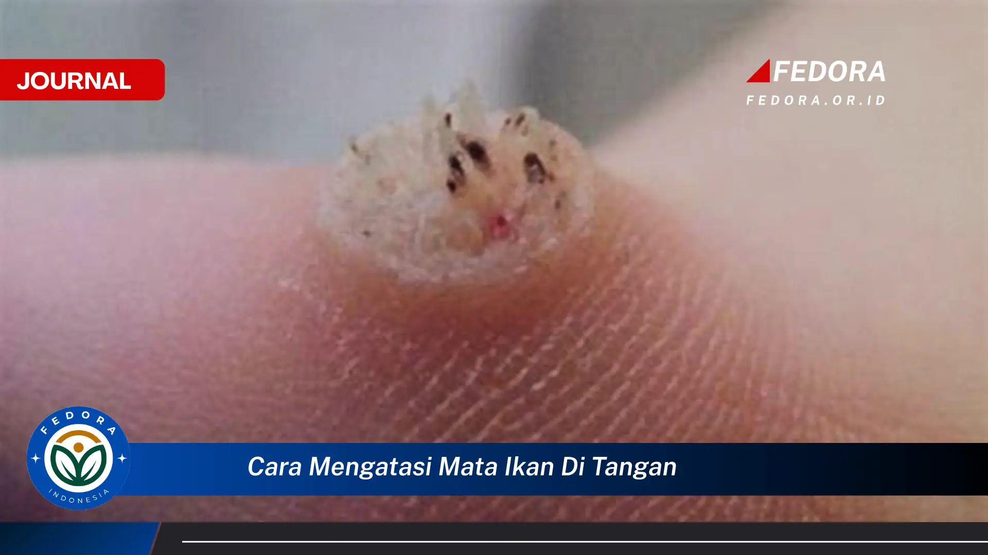 Temukan Cara Ampuh Mengatasi Mata Ikan di Tangan Secara Alami dan Medis