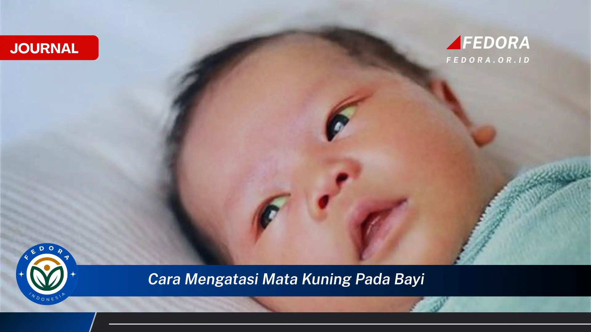 Ketahui Cara Mengatasi Mata Kuning pada Bayi Baru Lahir Secara Efektif dan Aman