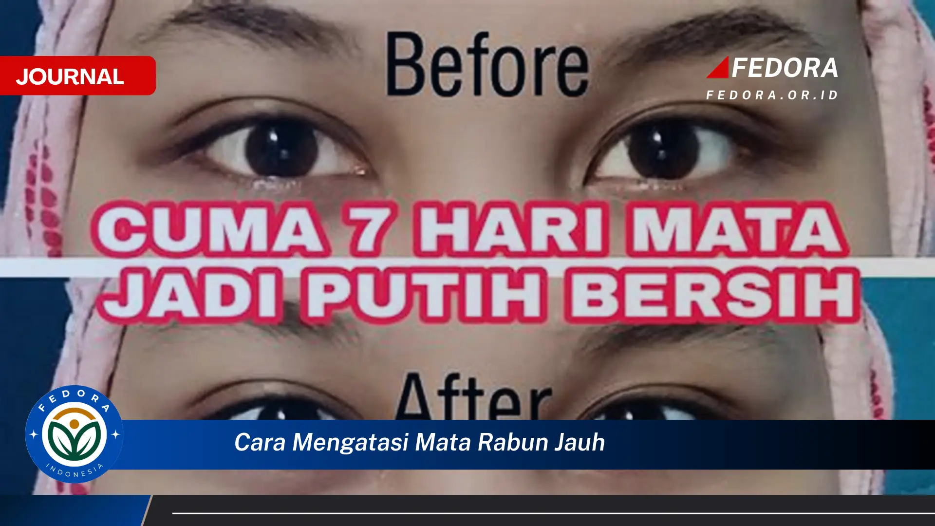 Ketahui Cara Mengatasi Mata Rabun Jauh, Tips, Latihan, dan Solusi Medis