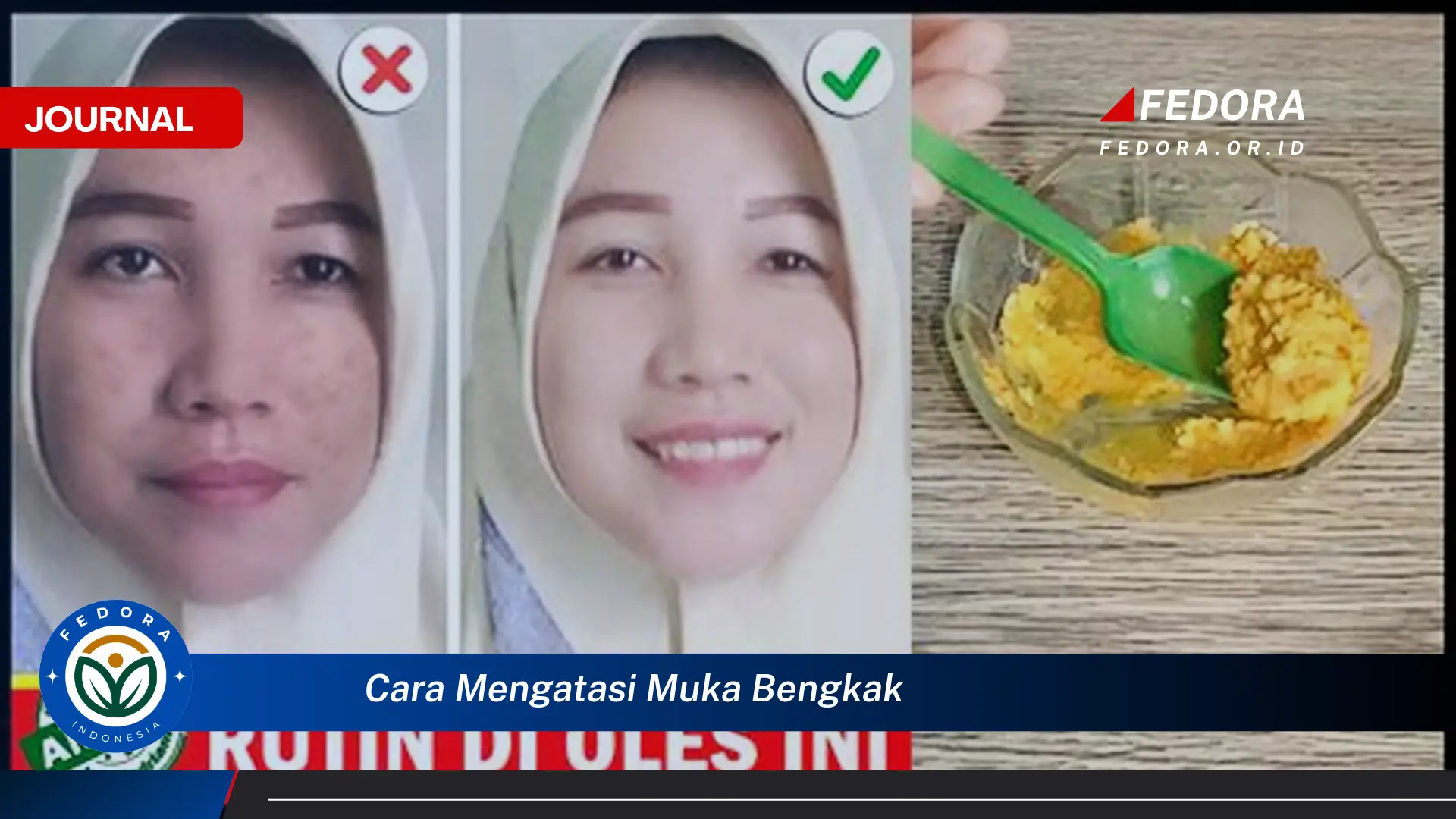 Ketahui Cara Mengatasi Muka Bengkak Secara Alami dan Cepat