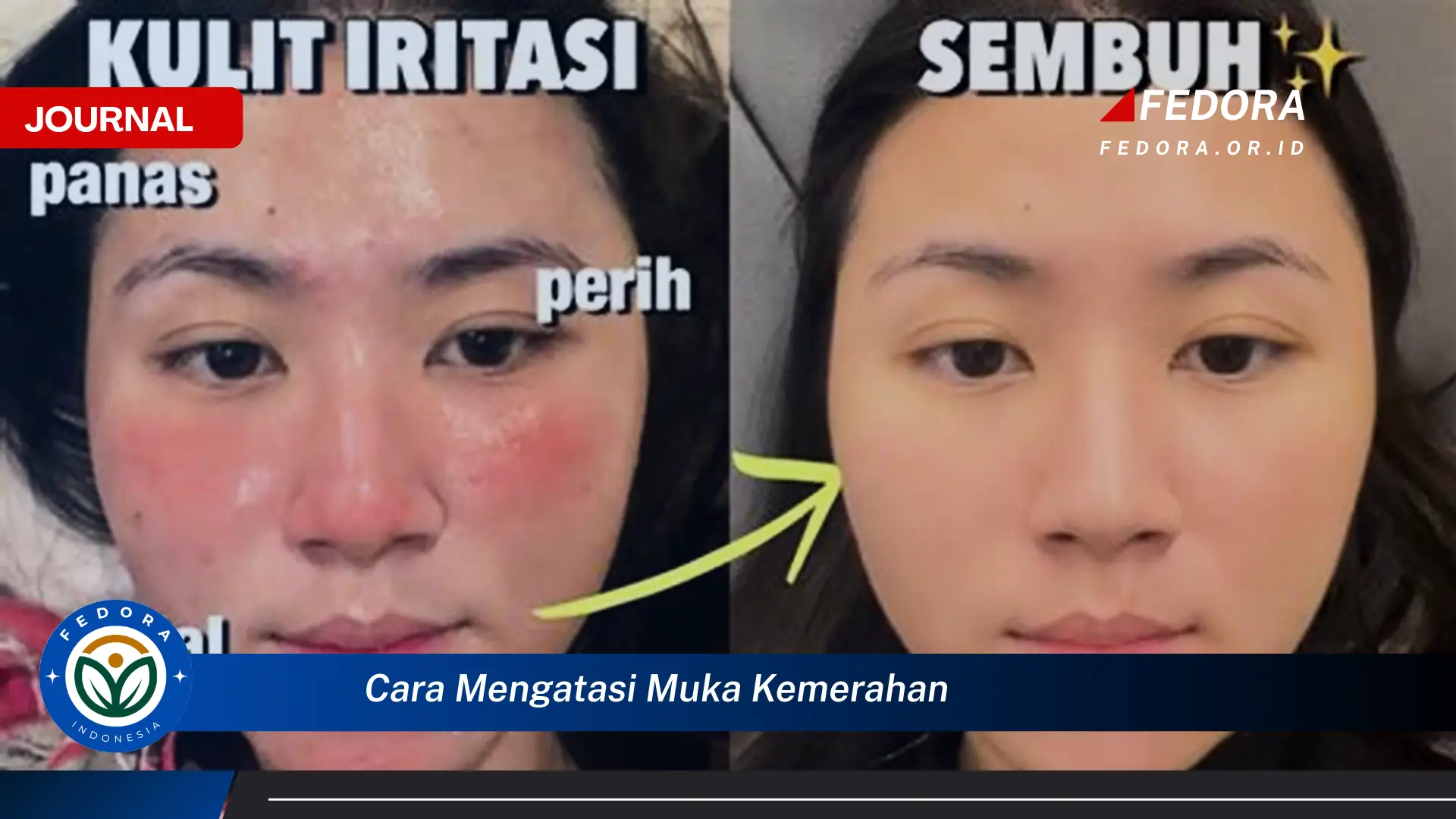Ketahui Cara Mengatasi Muka Kemerahan dengan Cepat dan Alami