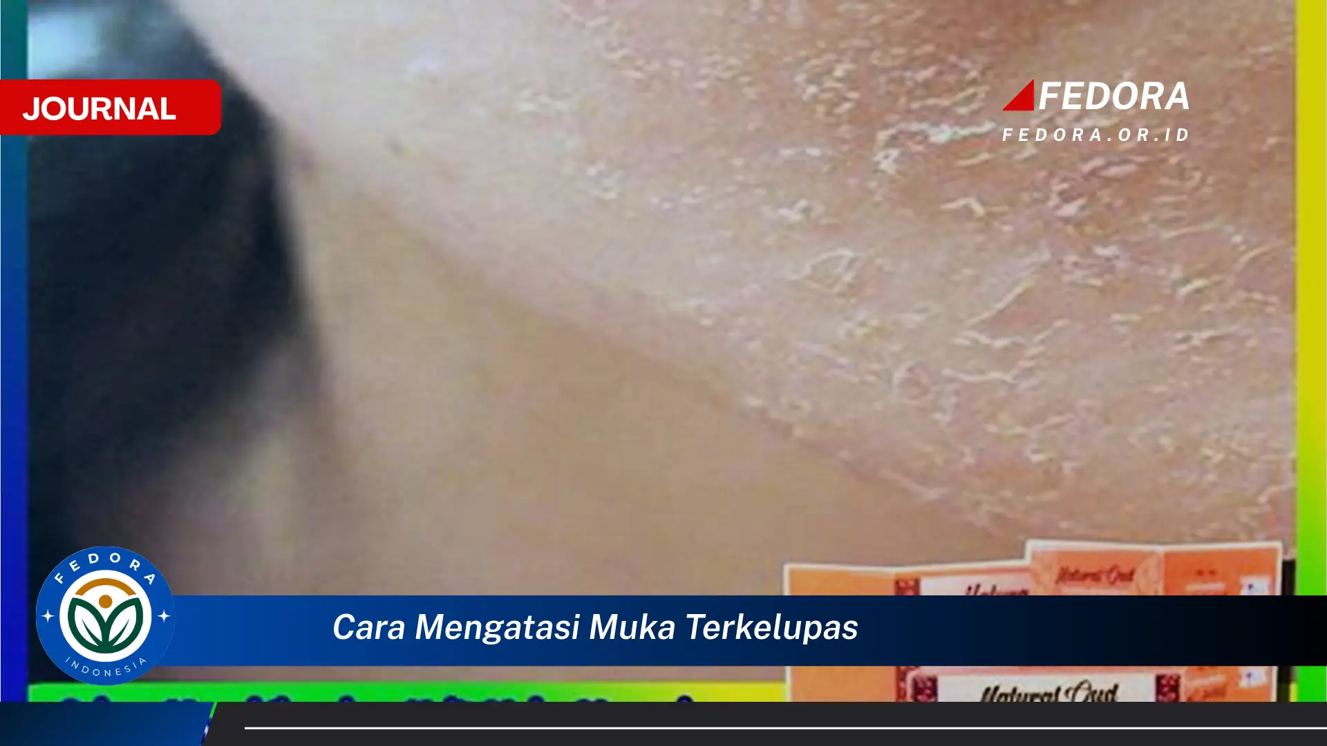 Ketahui Cara Mengatasi Muka Terkelupas dengan Cepat dan Ampuh