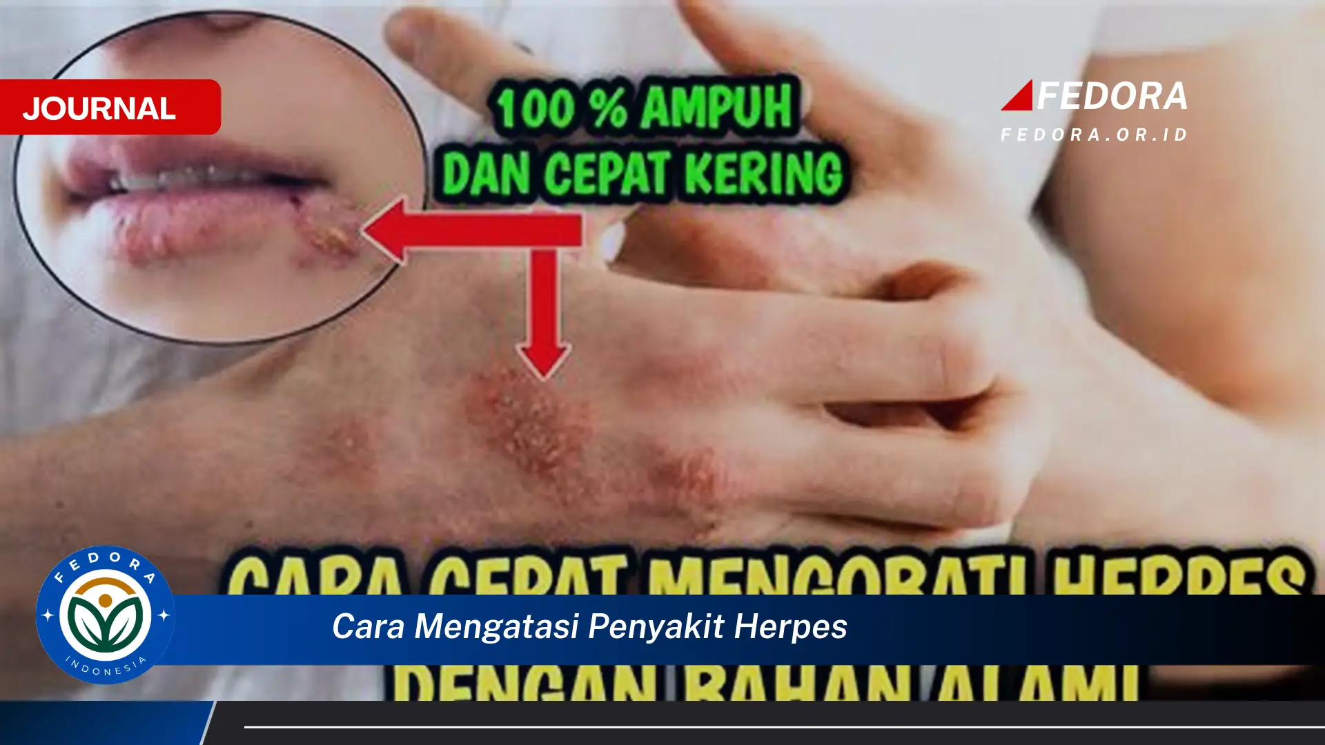 Ketahui Cara Mengatasi Penyakit Herpes, Panduan Lengkap dan Efektif