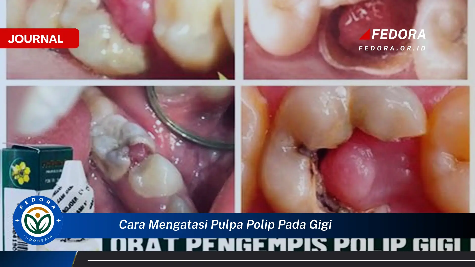 Ketahui Cara Mengatasi Pulpa Polip pada Gigi Secara Efektif dan Aman