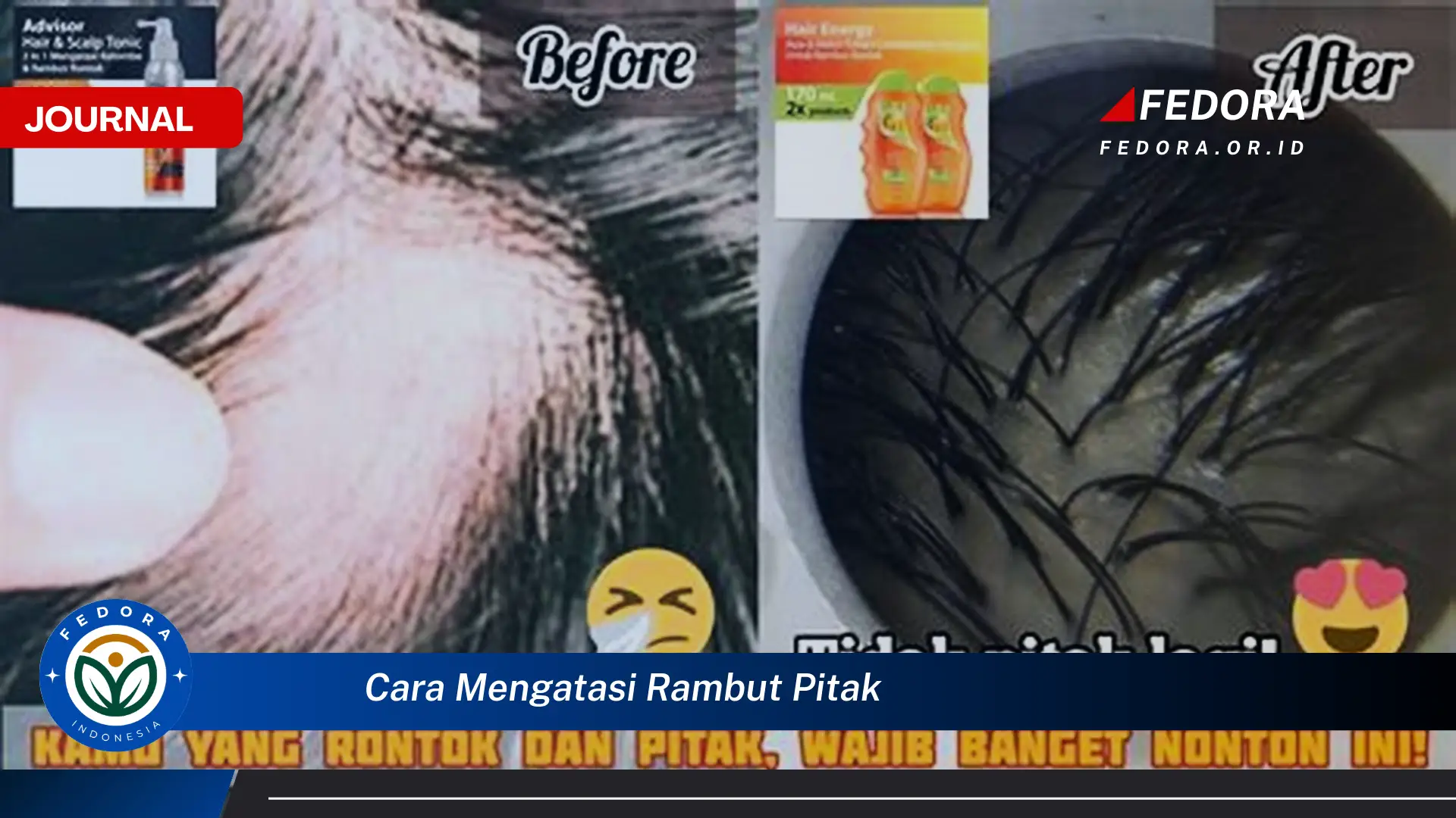 Ketahui Cara Mengatasi Rambut Pitak Secara Efektif dan Alami