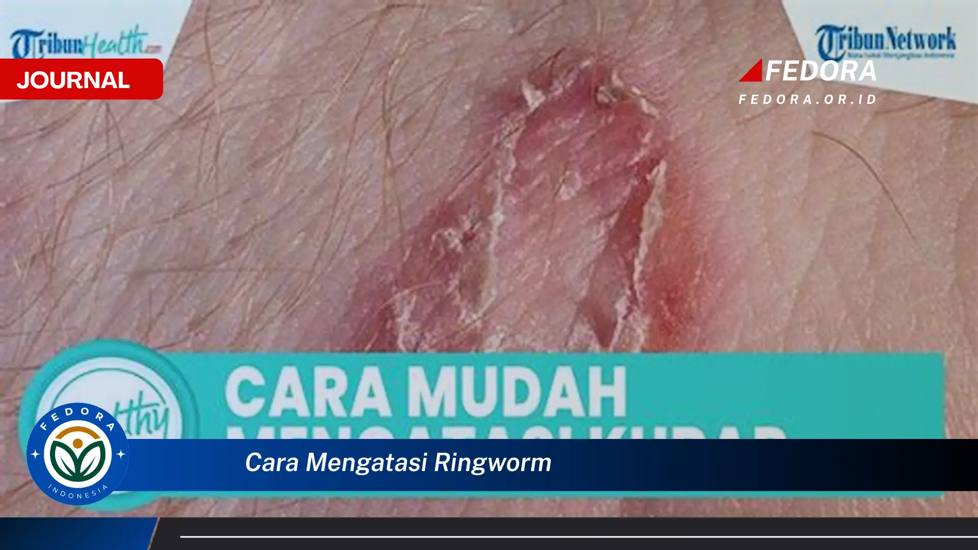 Ketahui Cara Mengatasi Ringworm dengan Cepat dan Efektif