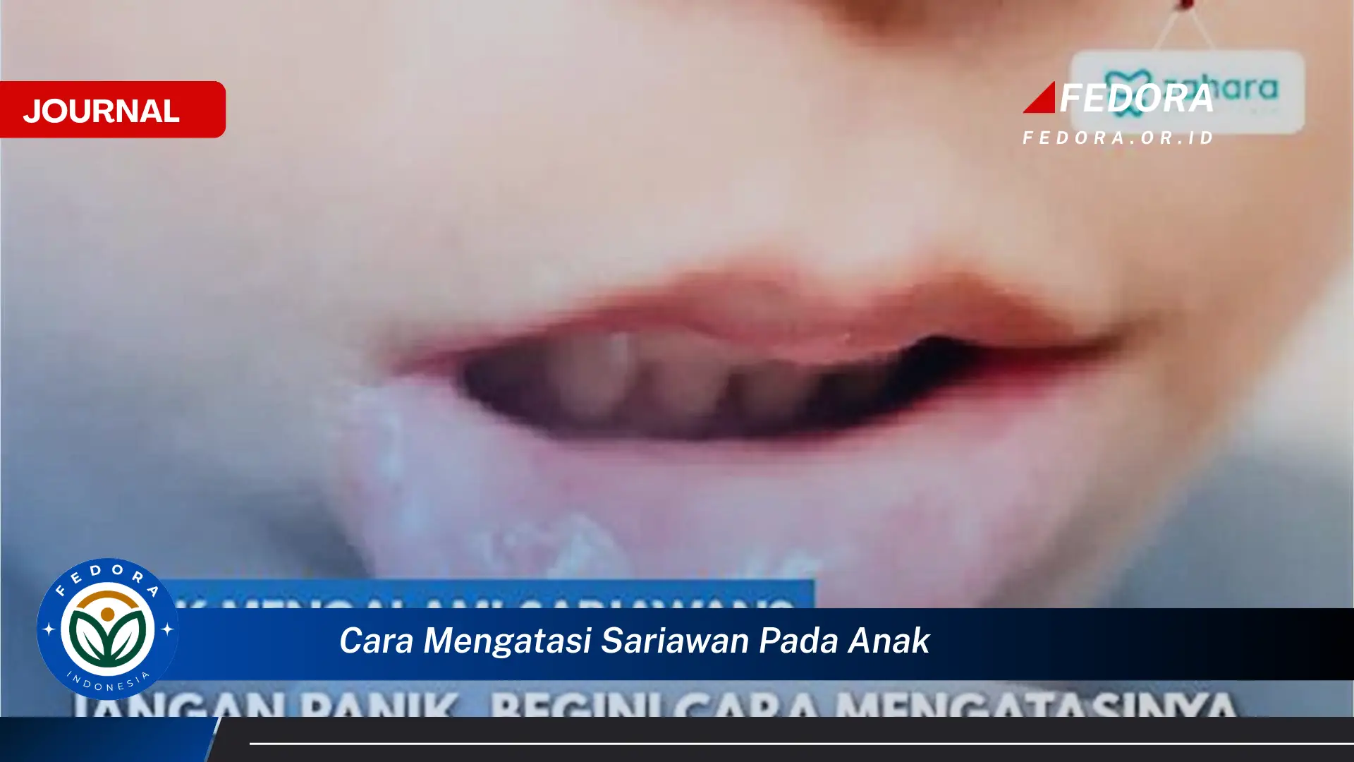 Ketahui Cara Mengatasi Sariawan Pada Anak Dengan Cepat dan Alami