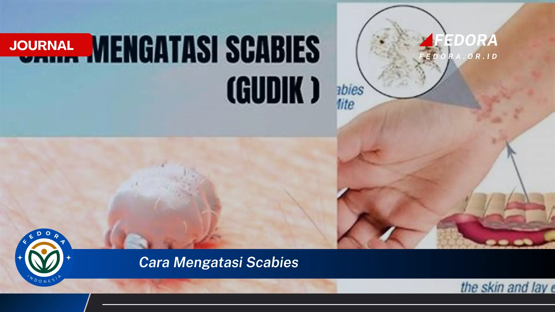 Ketahui Cara Mengatasi Scabies Secara Alami dan Efektif