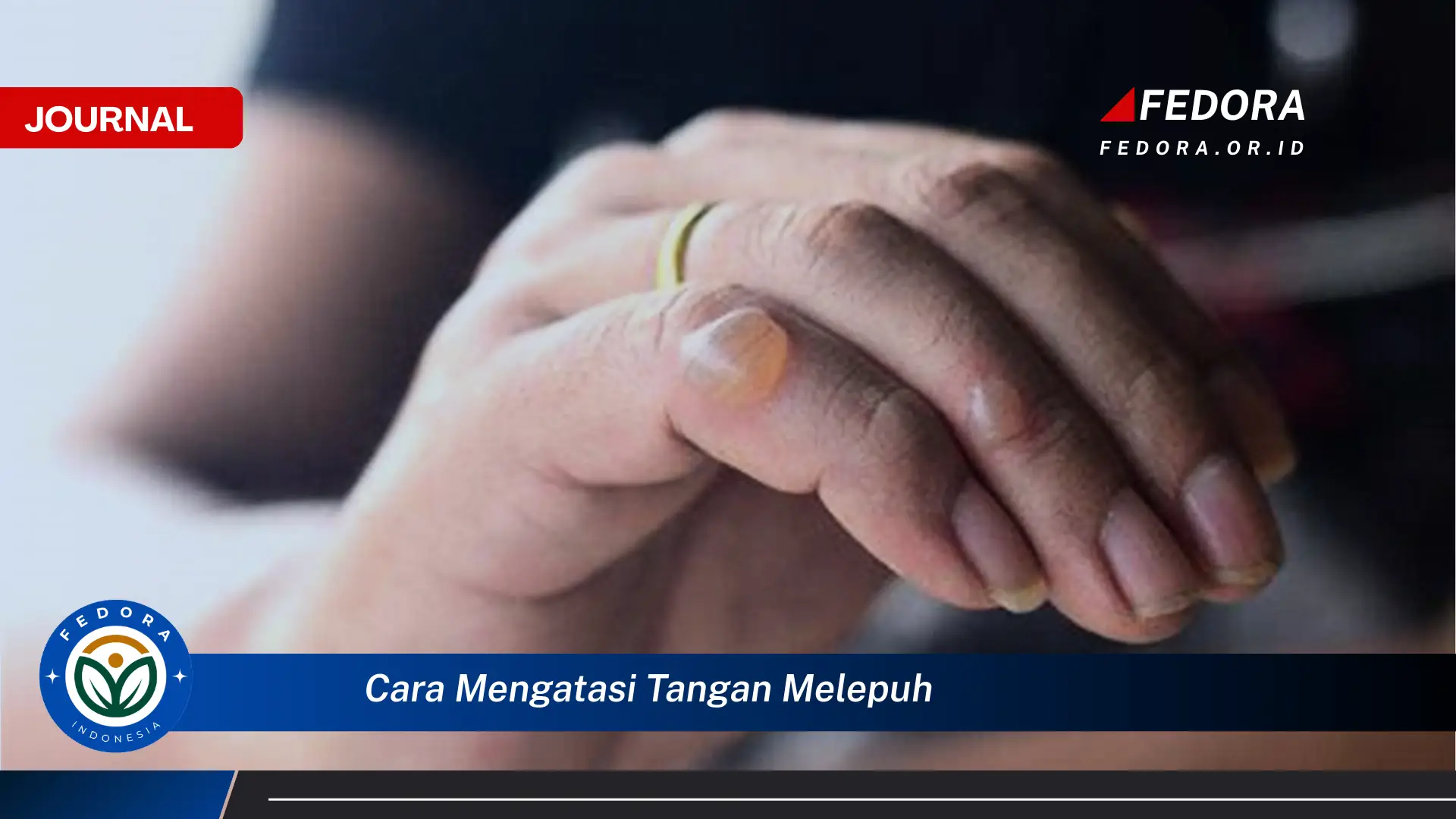 Ketahui Cara Mengatasi Tangan Melepuh Pertolongan Pertama dan Perawatan di Rumah