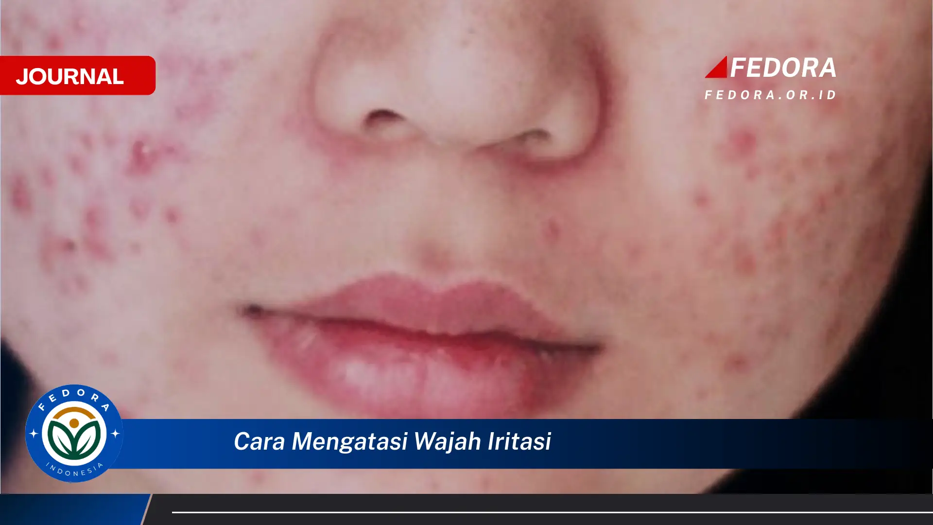 Inilah Cara Mengatasi Wajah Iritasi, Panduan Lengkap untuk Kulit Sensitif dan Kemerahan