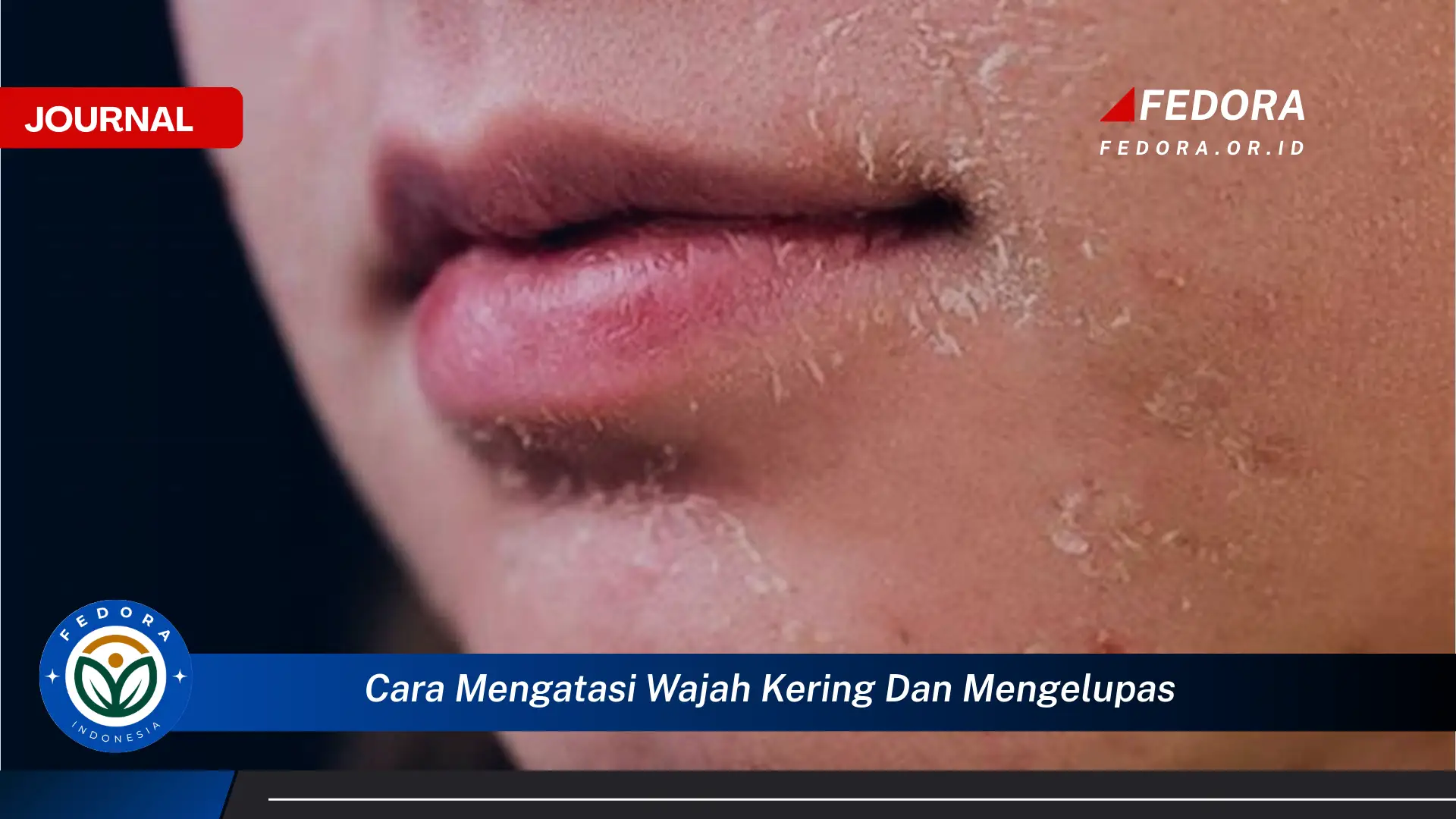 Ketahui Cara Mengatasi Wajah Kering dan Mengelupas Secara Alami dan Efektif